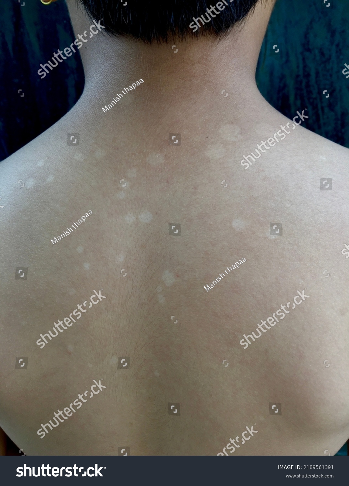 White Colour Patches Called Tinea Versicolor Stock Photo 2189561391 ...