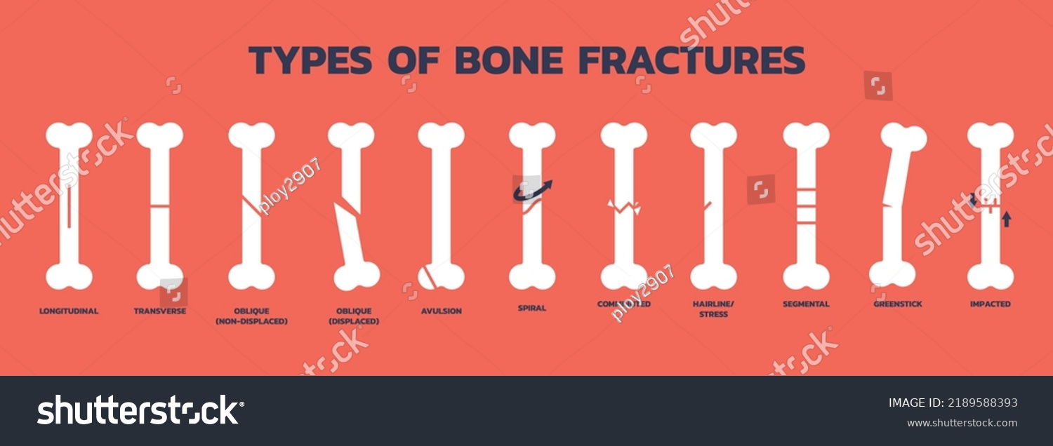 Types Bone Fractures Vector Illustration On Stock Vector (Royalty Free ...