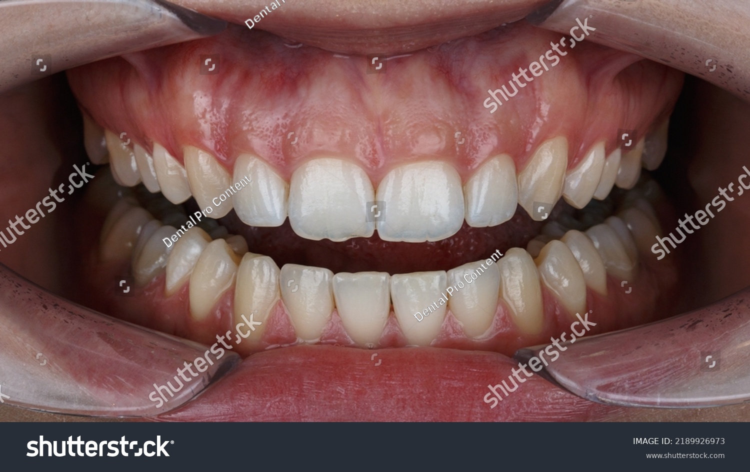 Patients Upper Jaw Gingiva Resection Stock Photo 2189926973 Shutterstock