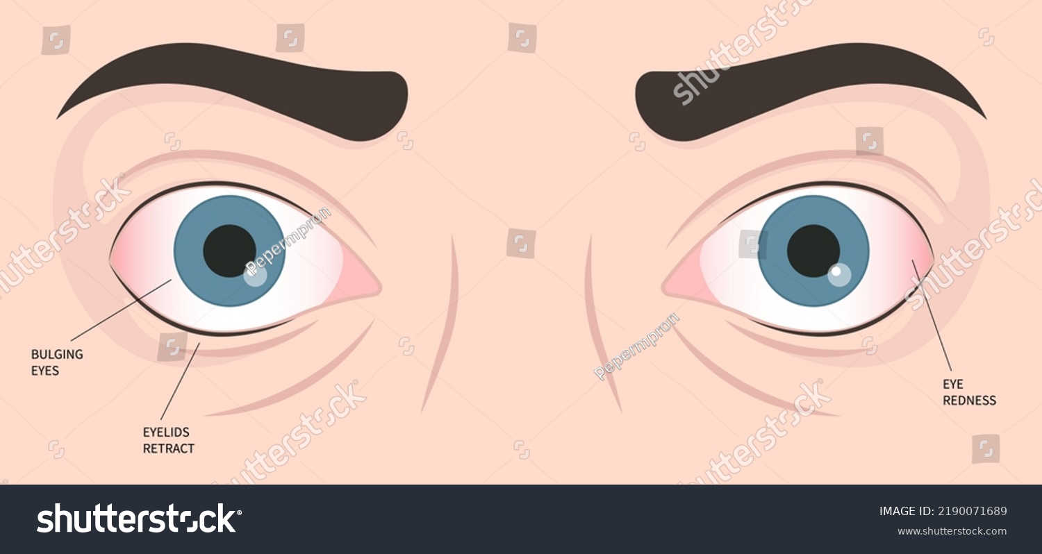 hashimotos-thyroiditis-graves-disease-eye-swollen-stock-vector-royalty