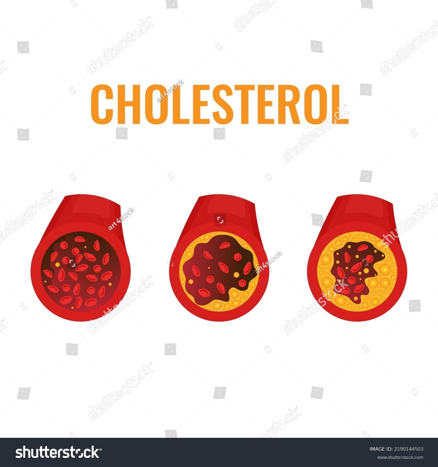 Cholesterol Plaque Blocked Blood Vessel Medical Stock Vector (Royalty