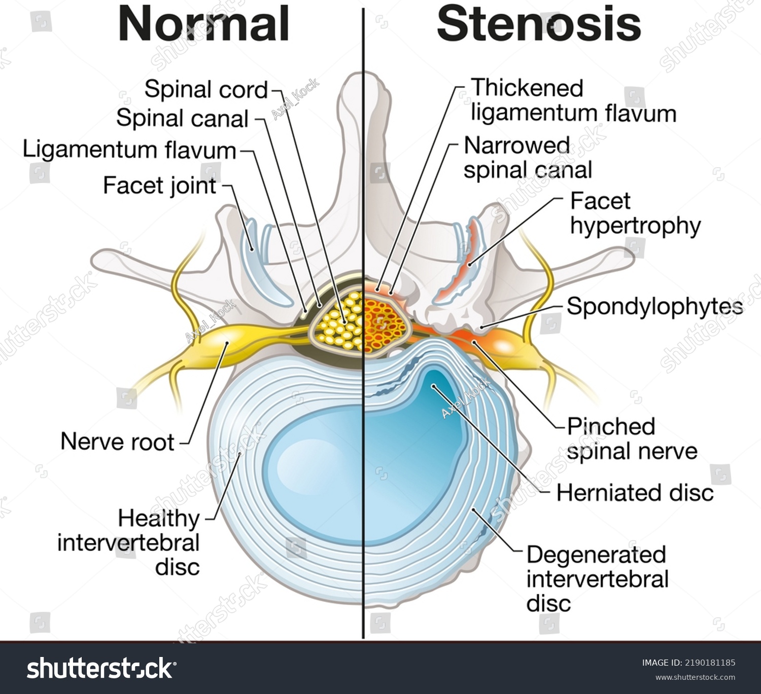 Illustration Showing Spinal Canal Stenosis Lumbar Stock Illustration ...