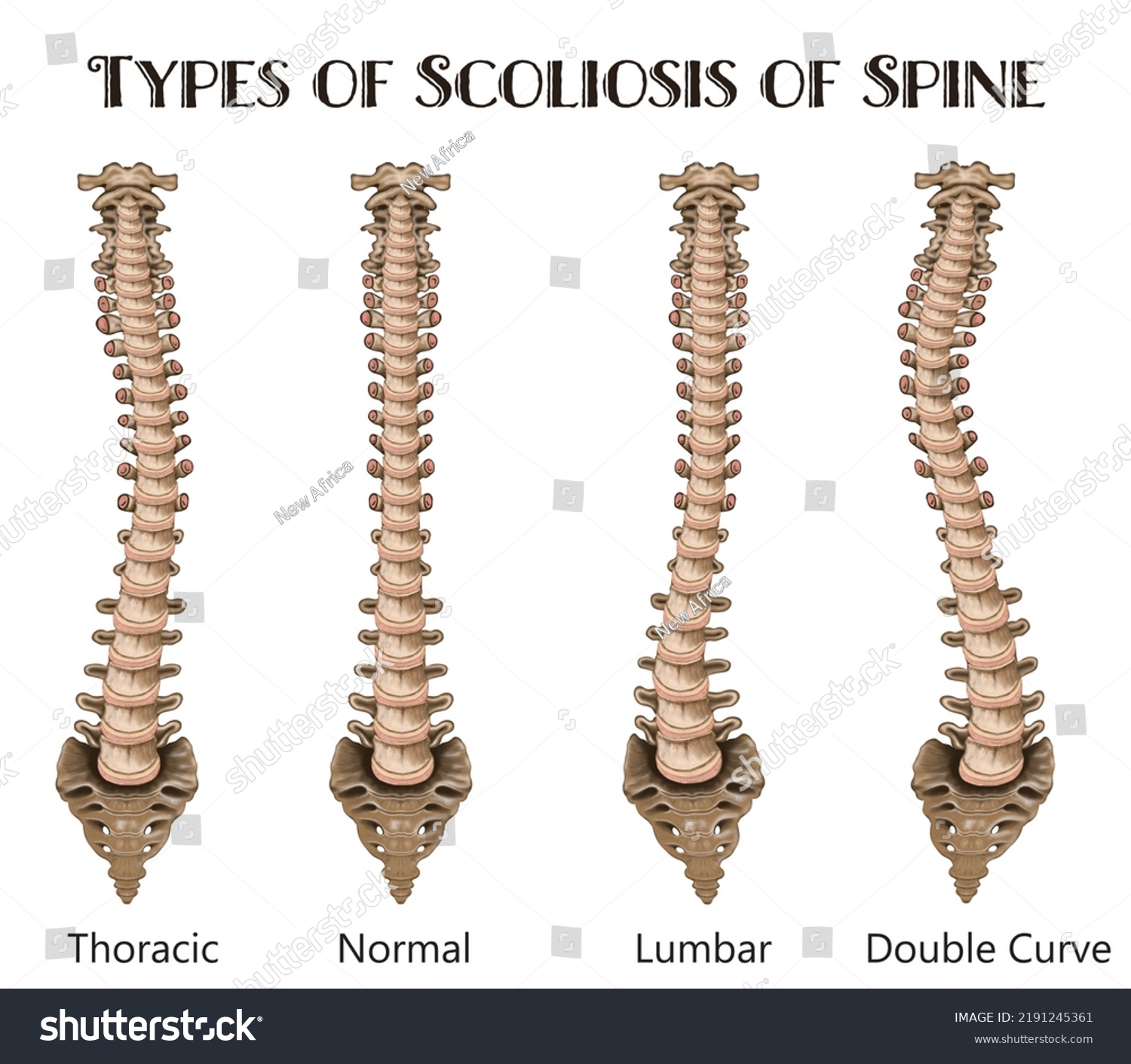 Medical Poster Demonstrating Types Scoliosis On Stock Illustration ...