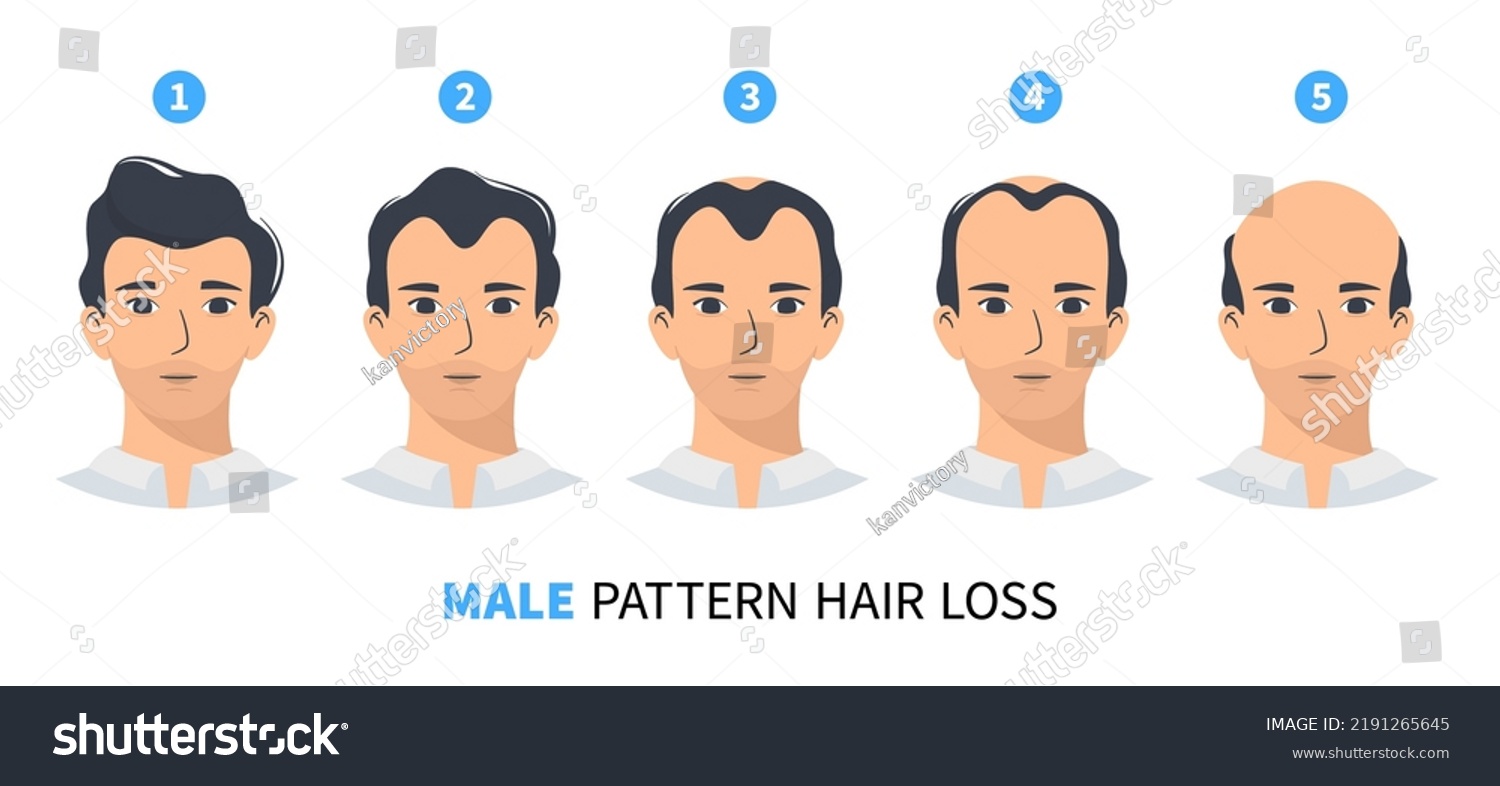 Hair Loss Stages Androgenetic Alopecia Male Stock Vector (Royalty Free ...