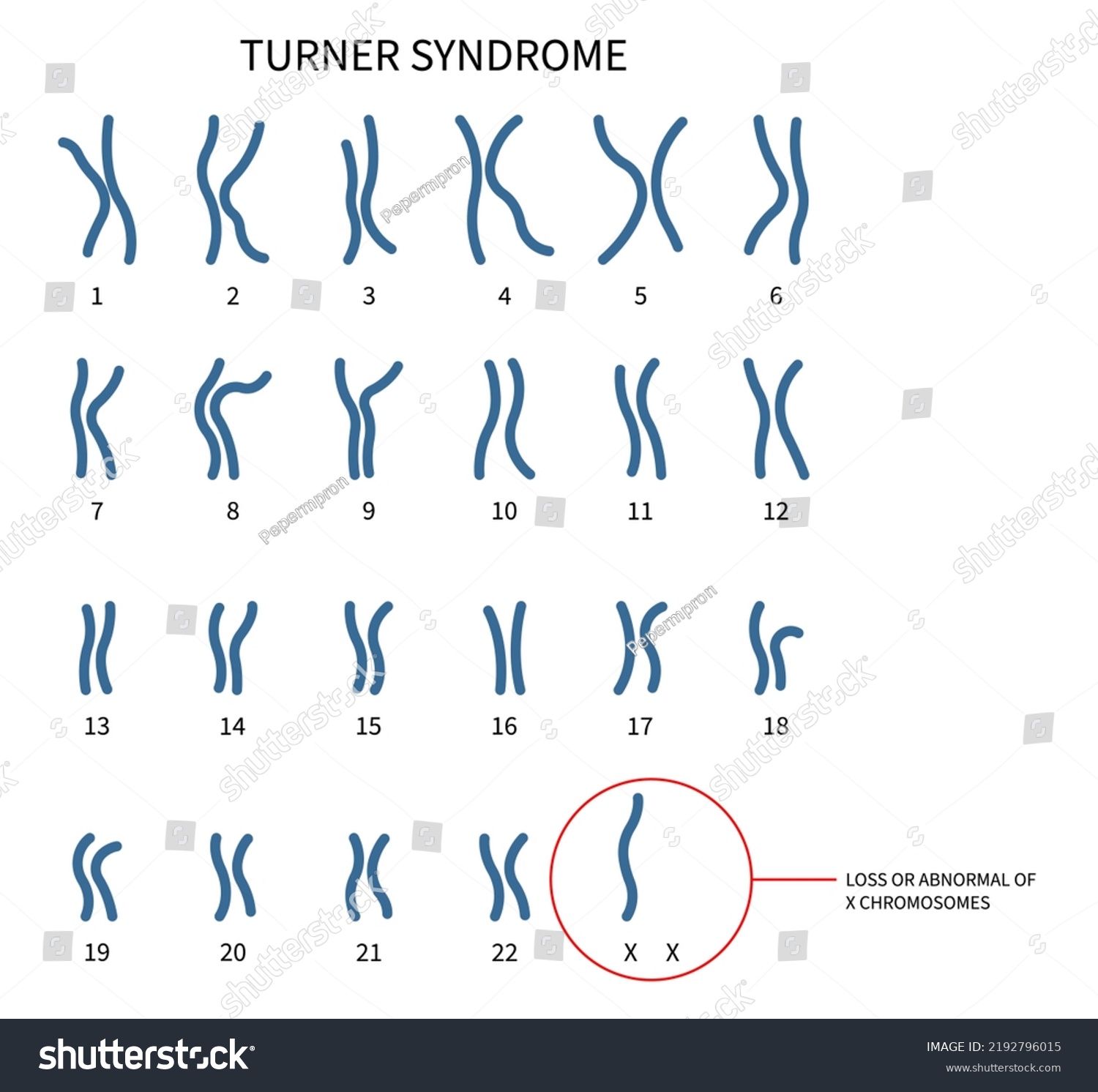 Turner Fragile Syndrome X Chromosomal Abnormality Stock Vector (Royalty ...