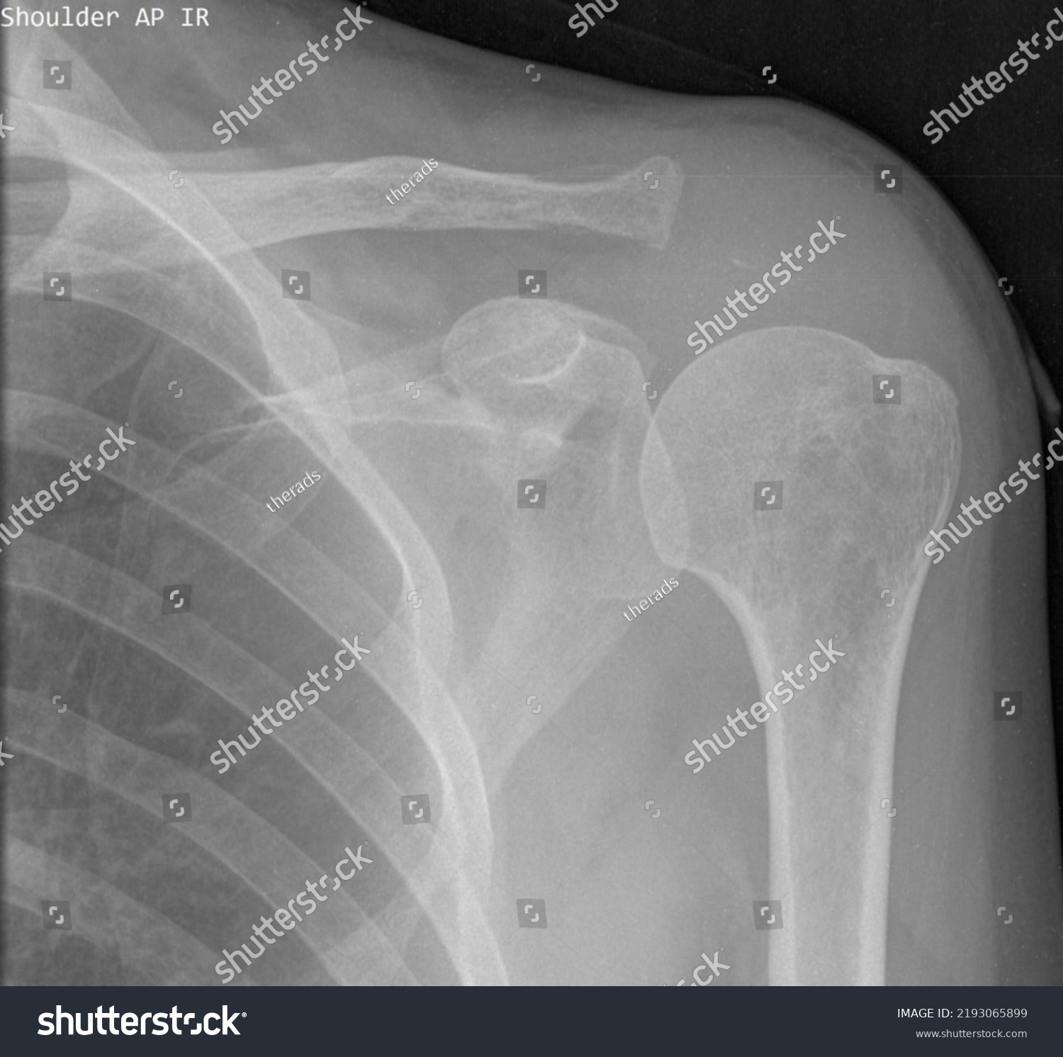 X Ray Image Absence Acromion Stock Photo 2193065899 | Shutterstock