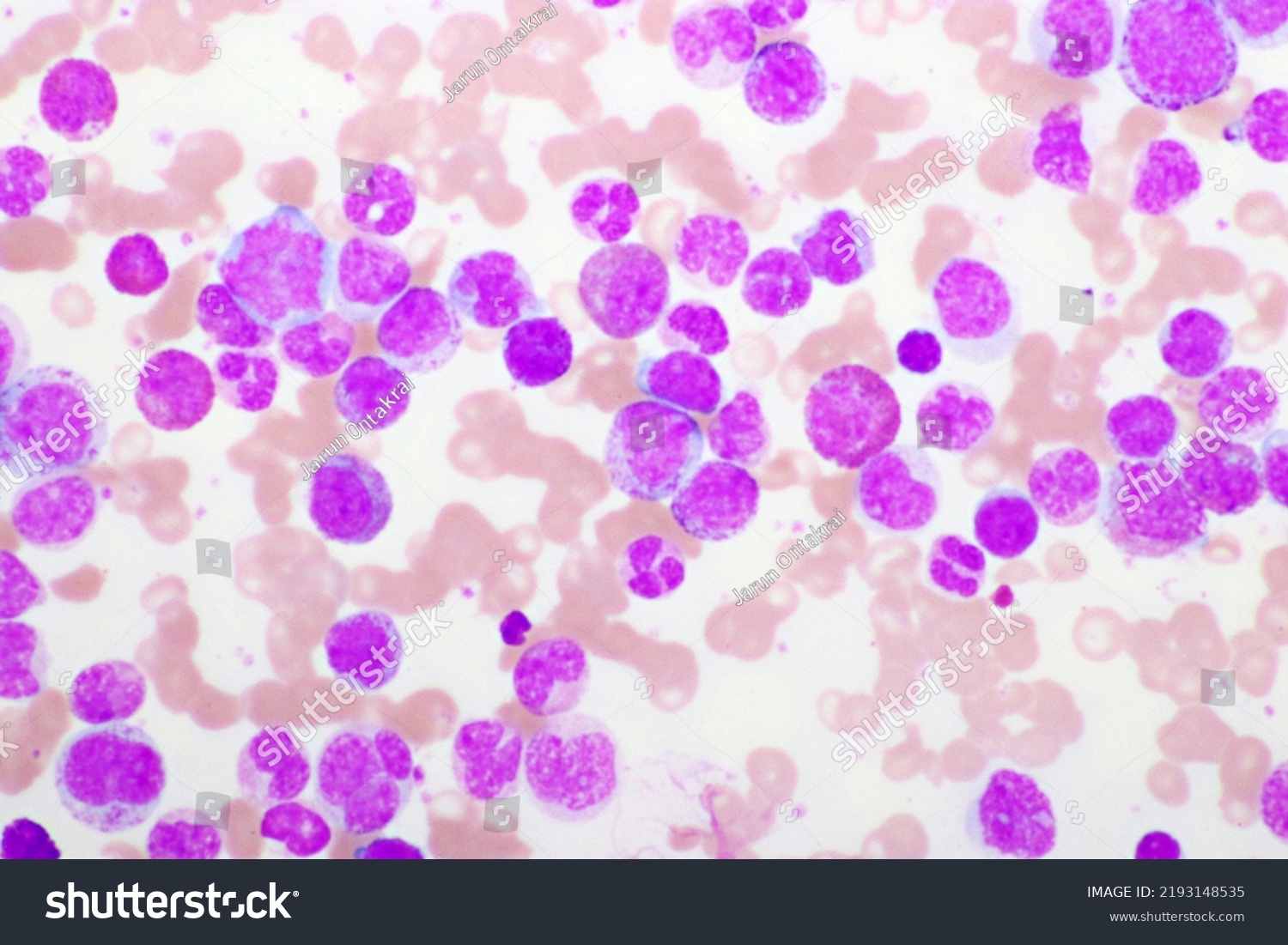 Acute Promyelocytic Leukemia Cells Apl Analyze Stock Photo 2193148535 ...