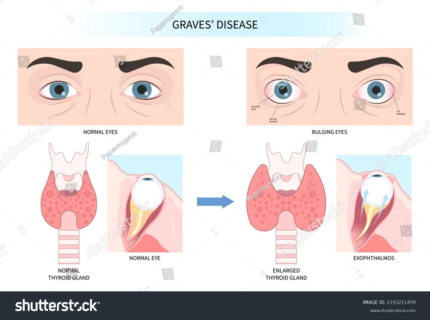 hyperthyroidism-disease-symptoms-that-cause-swollen-stock-vector