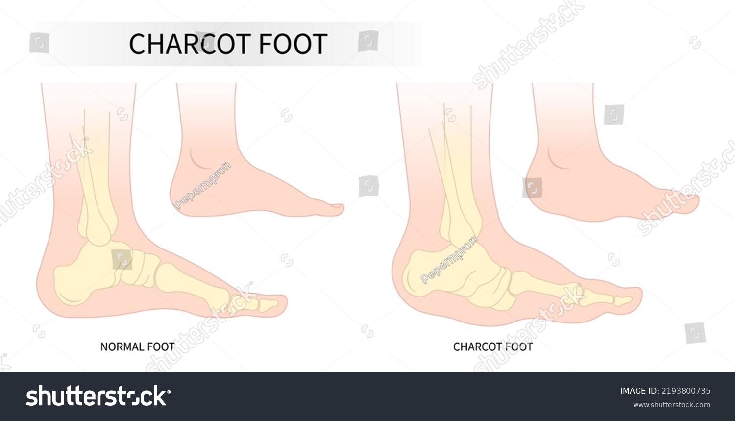 Anatomy Swelling Foot Abnormalities Bone Medical Stock Vector (Royalty ...