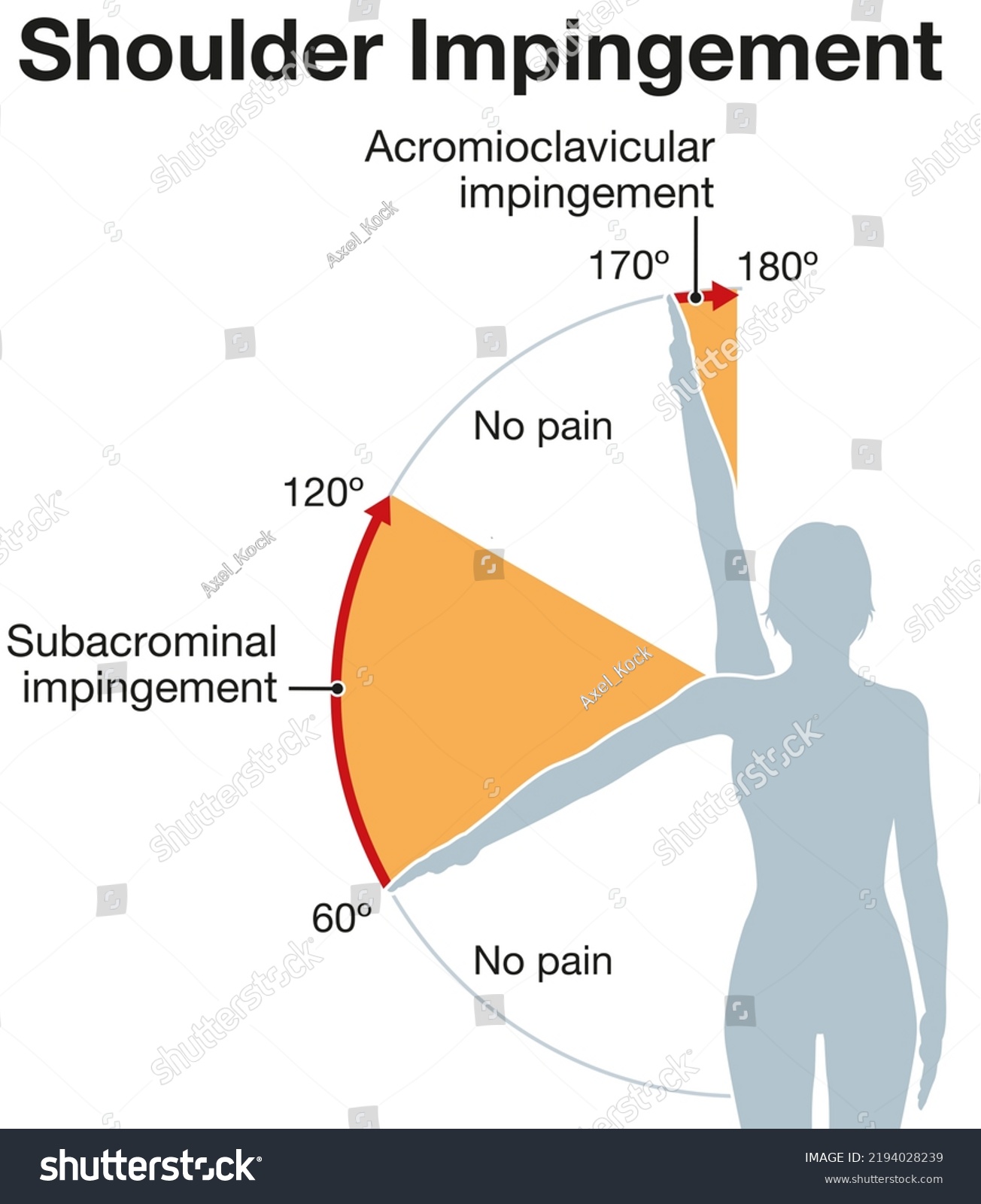 Illustration Showing Shoulder Impingement Syndrome Painful Stock ...