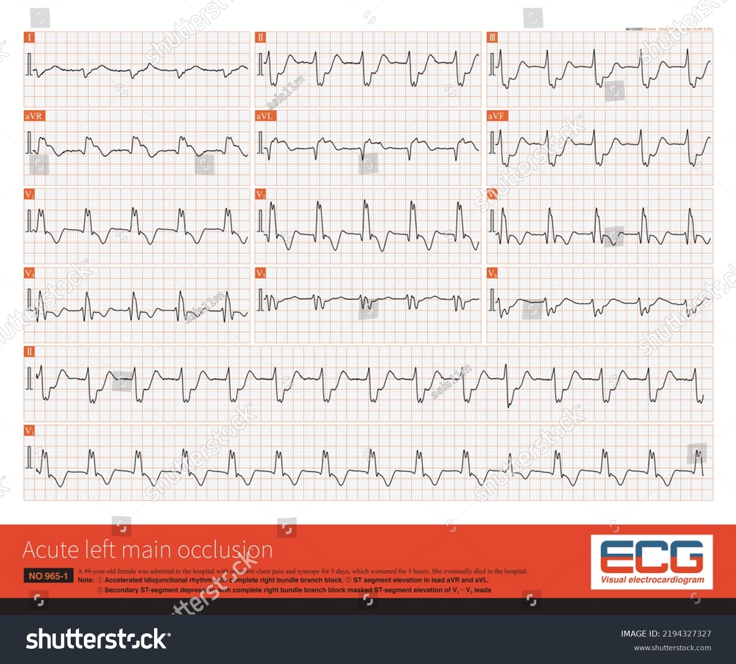 Coronary Angiography Showed Complete Occlusion Left Stock Illustration ...