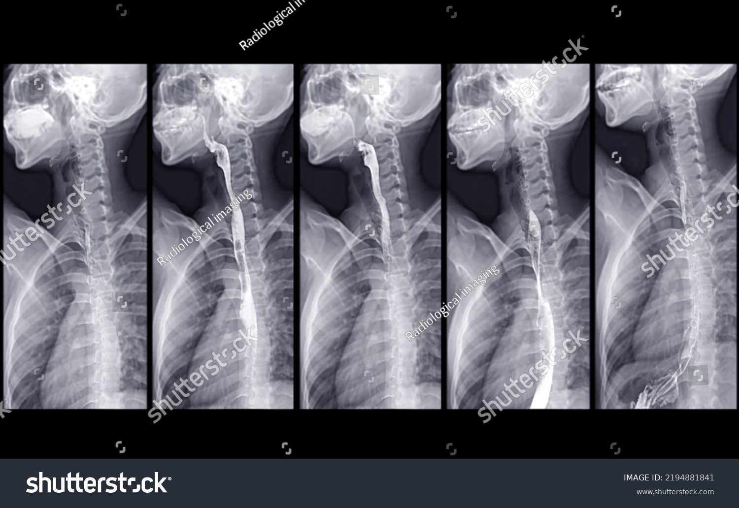 Barium Swallow Study Test Diagnose Barretts Stock Illustration ...