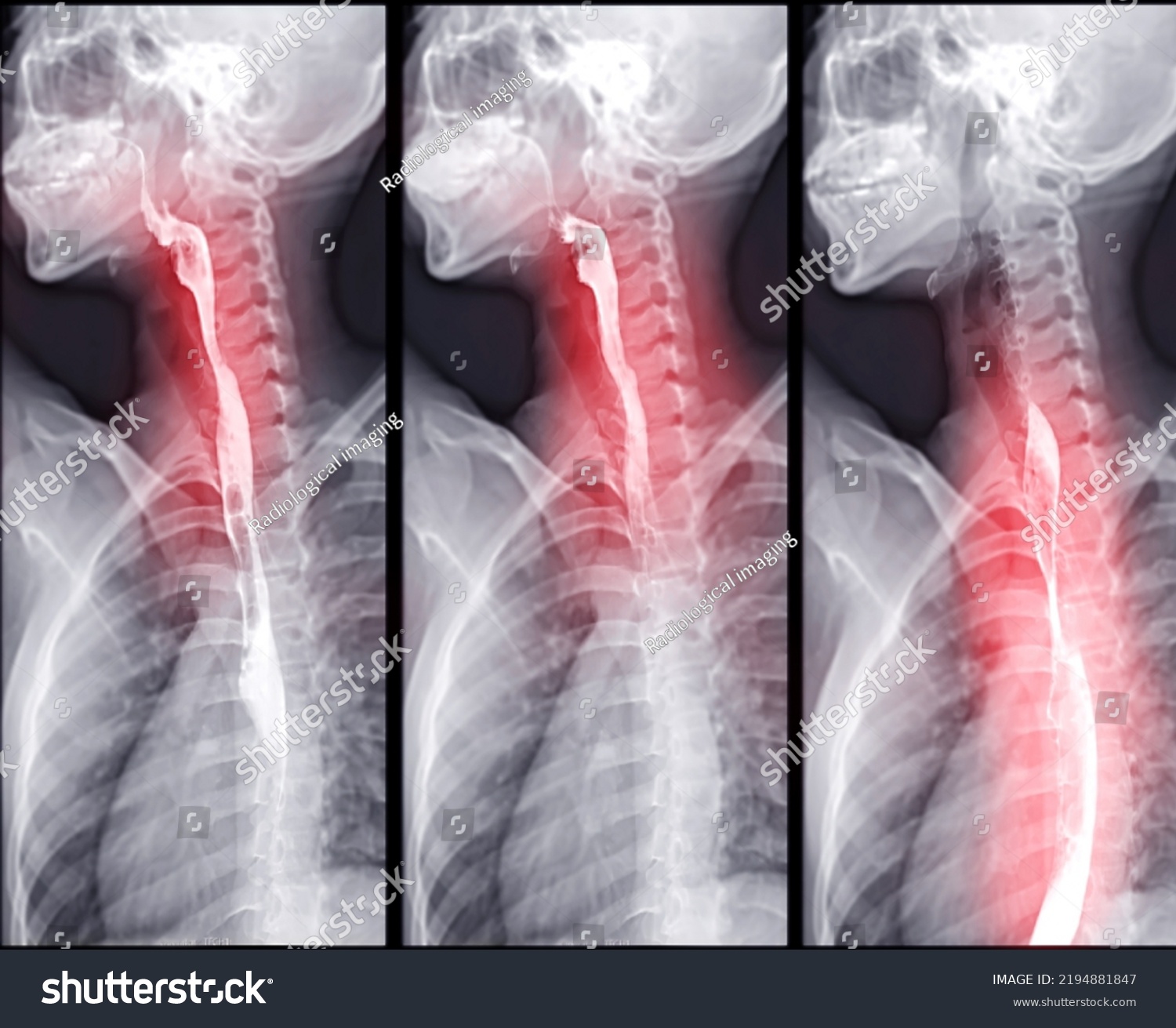 Barium Swallow Study Test Diagnose Barretts Stock Illustration ...