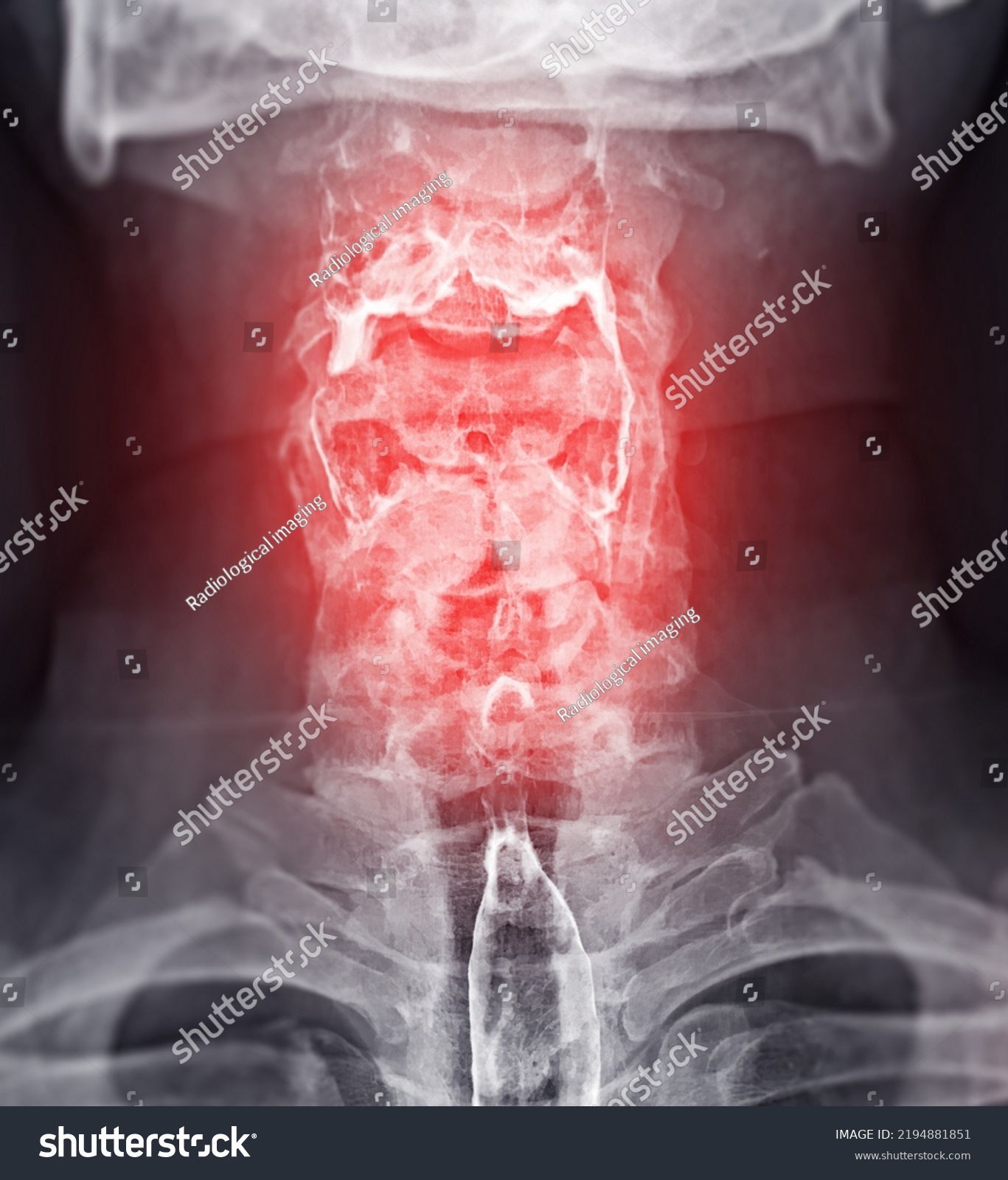 Barium Swallow Study Test Diagnose Barretts Stock Illustration ...