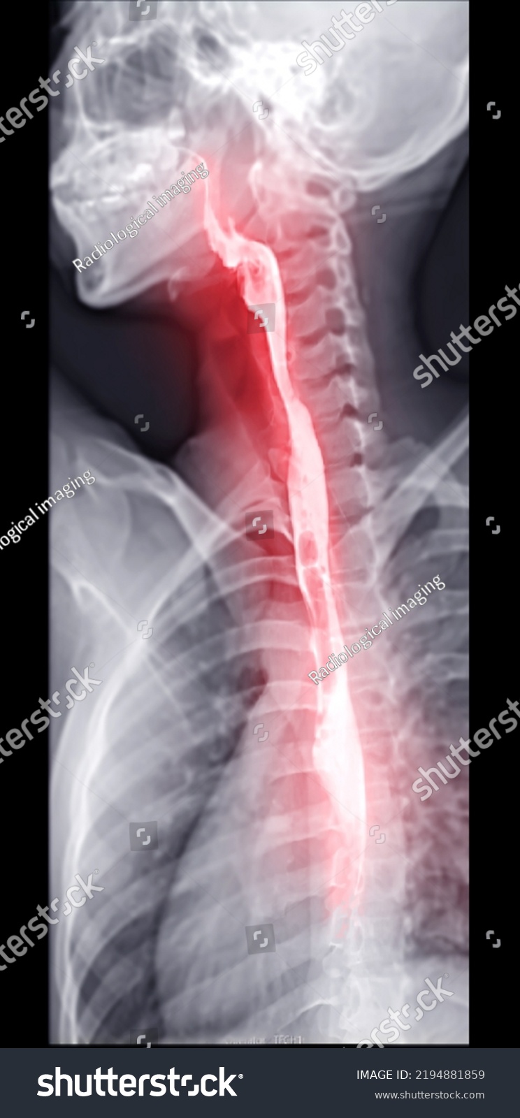 Barium Swallow Study Test Diagnose Barretts Stock Illustration ...