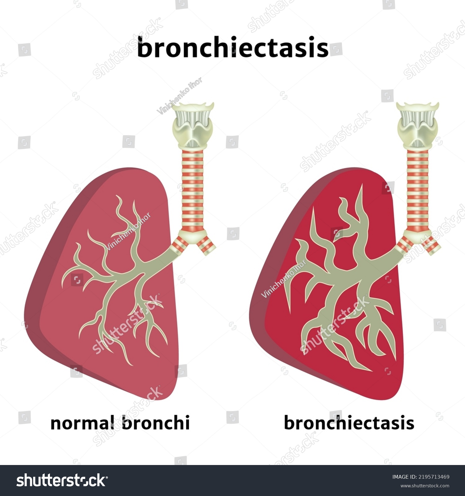 Bronchiectasis Enlargement Airway Lumen Inflammation Bronchi Stock ...