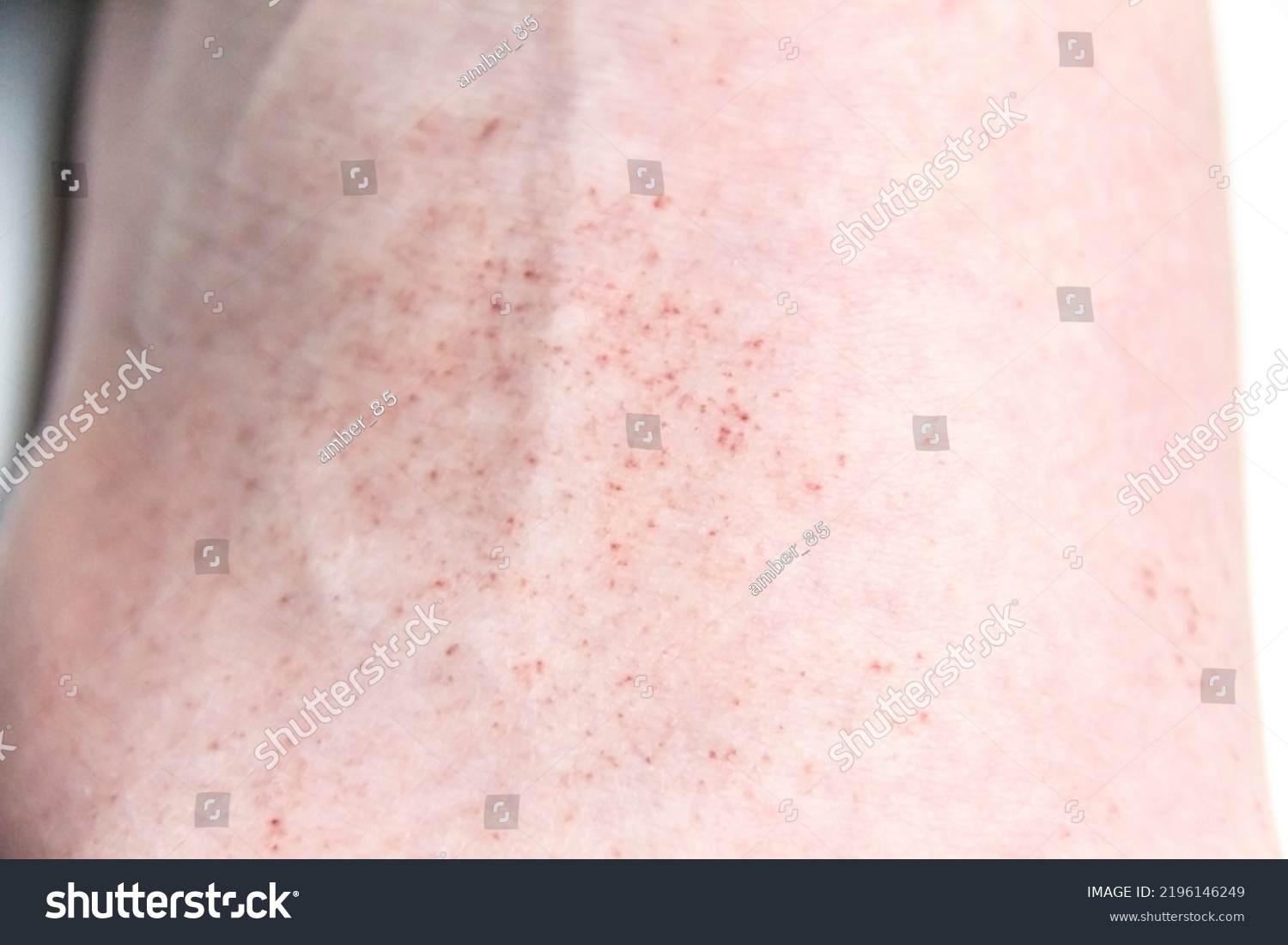 red-rash-on-foot-male-against-stock-photo-2196146249-shutterstock