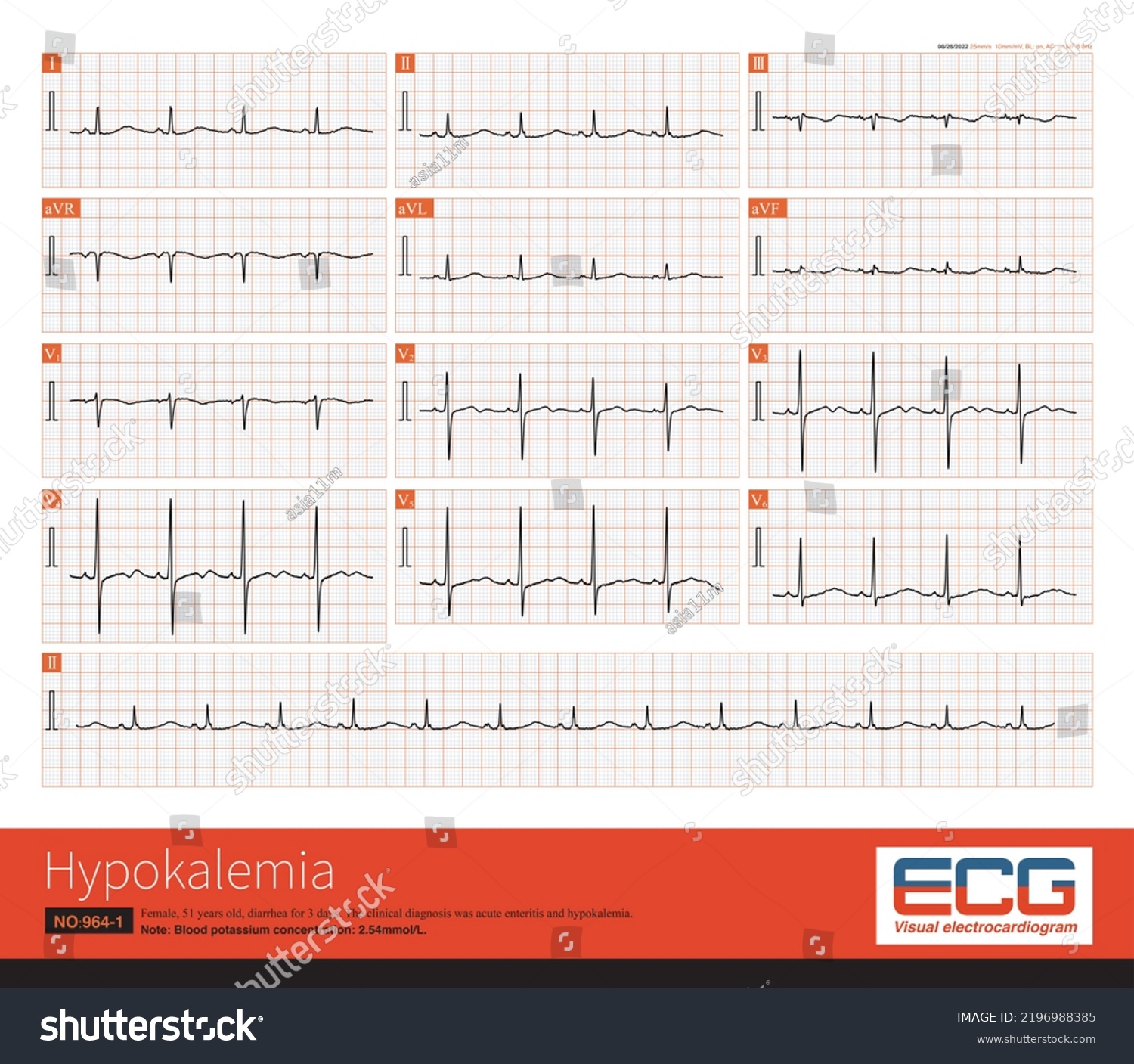 Patient Suffered Hypokalemia Due Diarrhea Note Stock Illustration ...