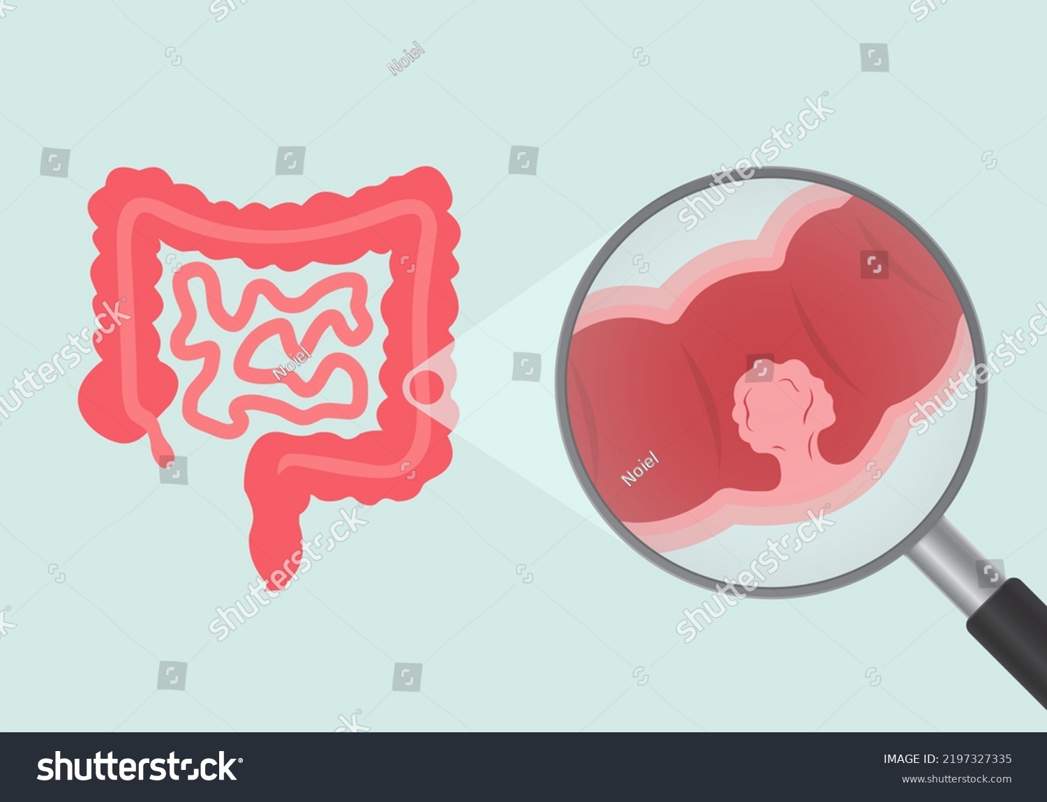 colon-polyps-learn-the-facts-here-step-to-health