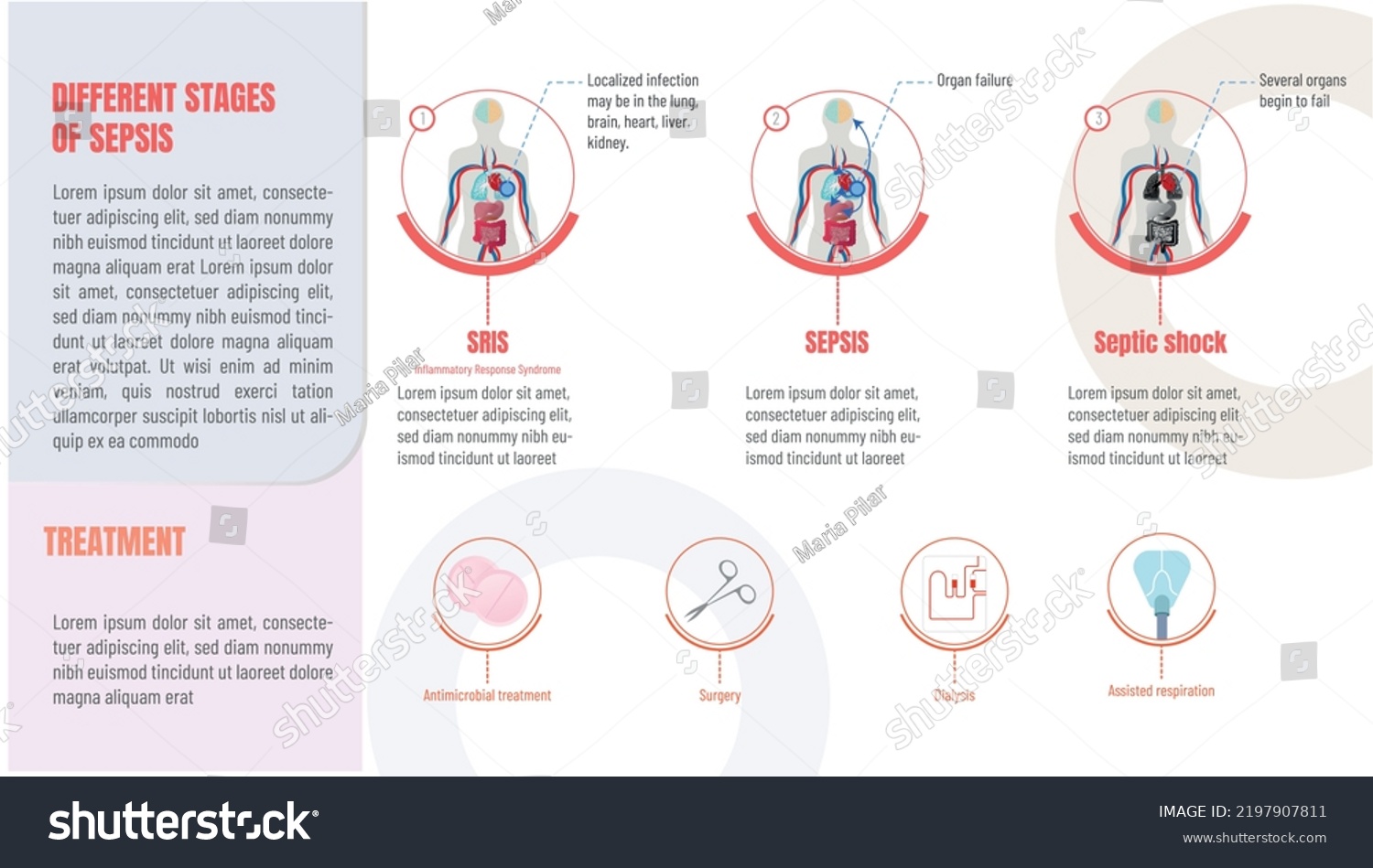 Infographics Evolution Sepsis Stages Possible Treatments Stock Vector ...