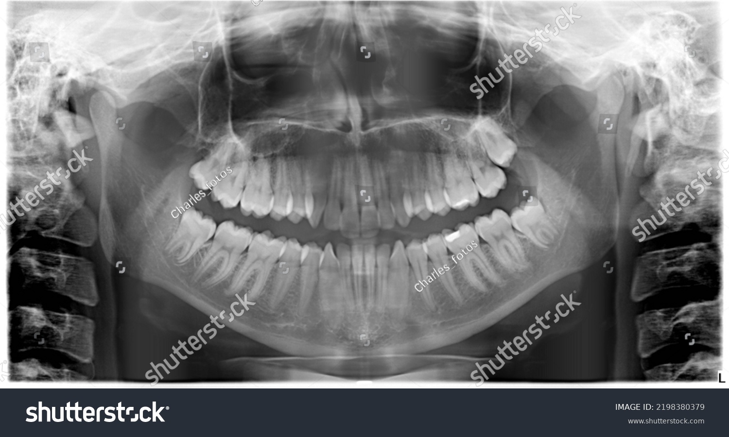 Orthopantomographies Dental Xrays Patients Fractures Cavities Stock ...