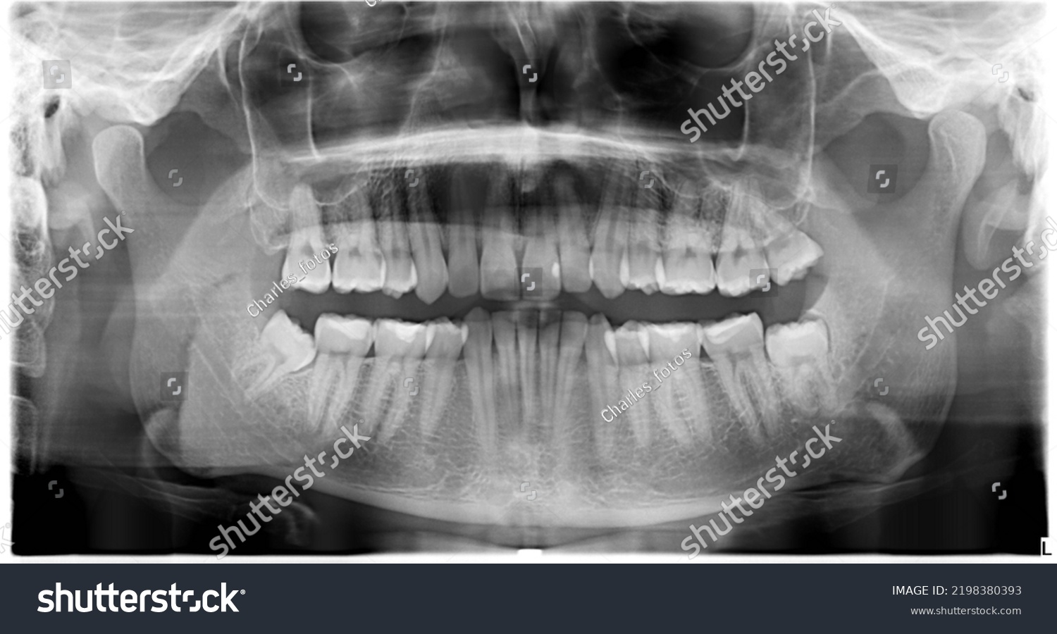 Orthopantomographies Dental Xrays Patients Fractures Cavities Stock ...