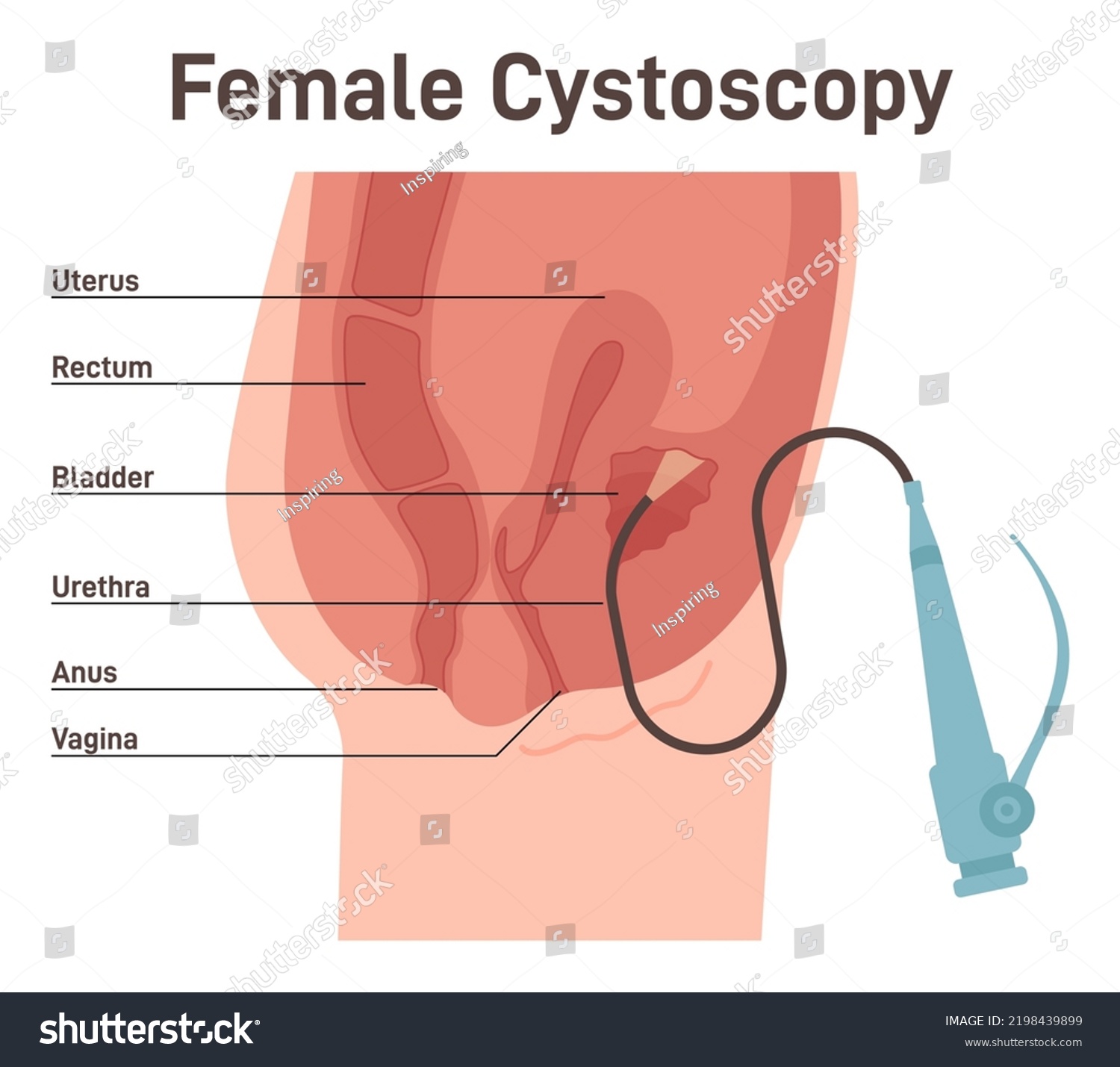 Cystoscopy Female Bladder Surface Examination Flexible Stock Vector Royalty Free 2198439899 4883