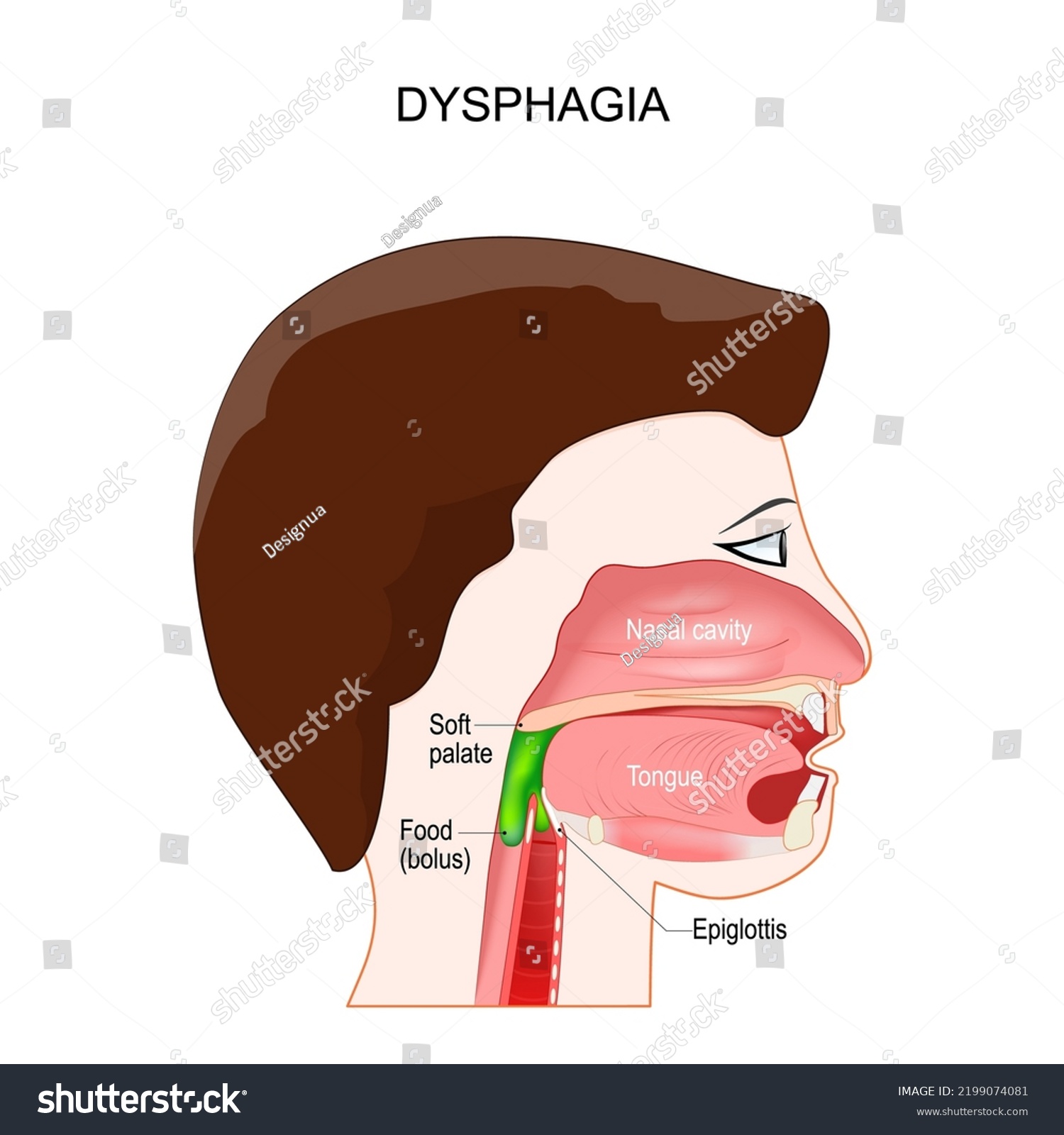 Dysphagia Aspiration Food Liquid Into Lungs Stock Vector Royalty Free