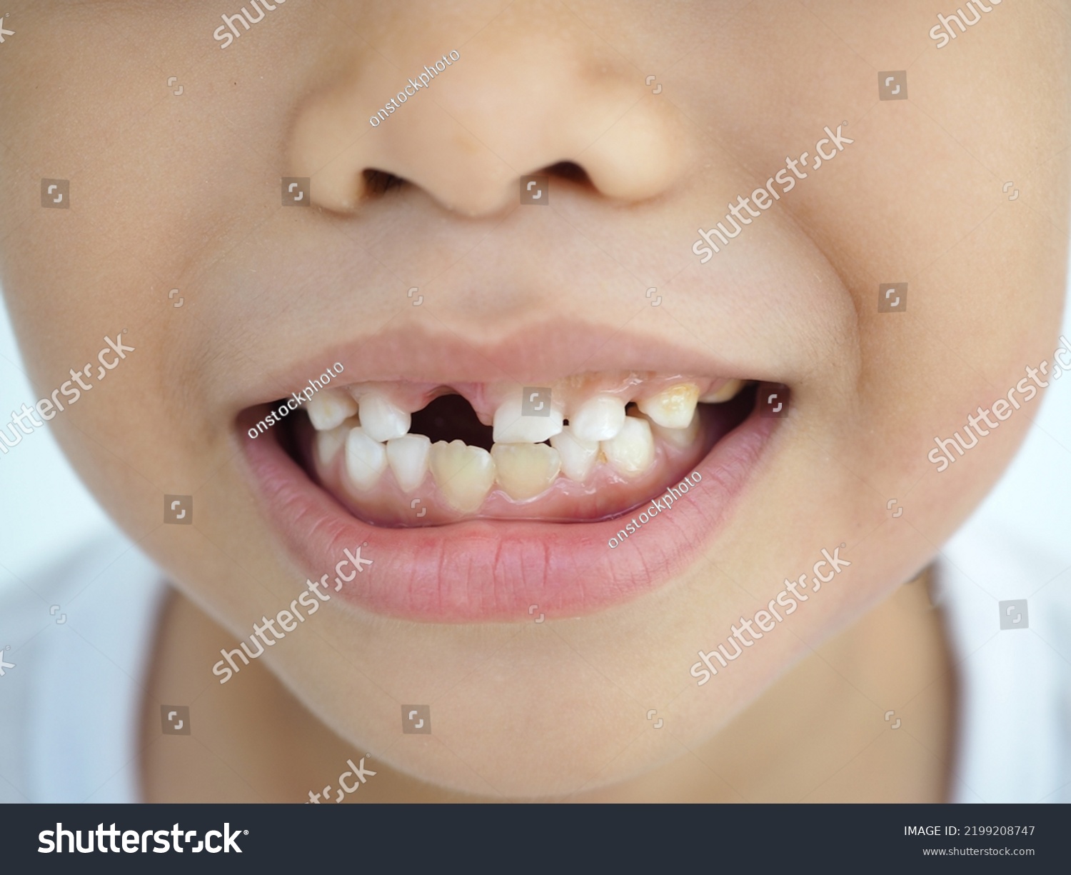 Portrait Boy Bad Teeth Kid Patient Stock Photo 2199208747 | Shutterstock
