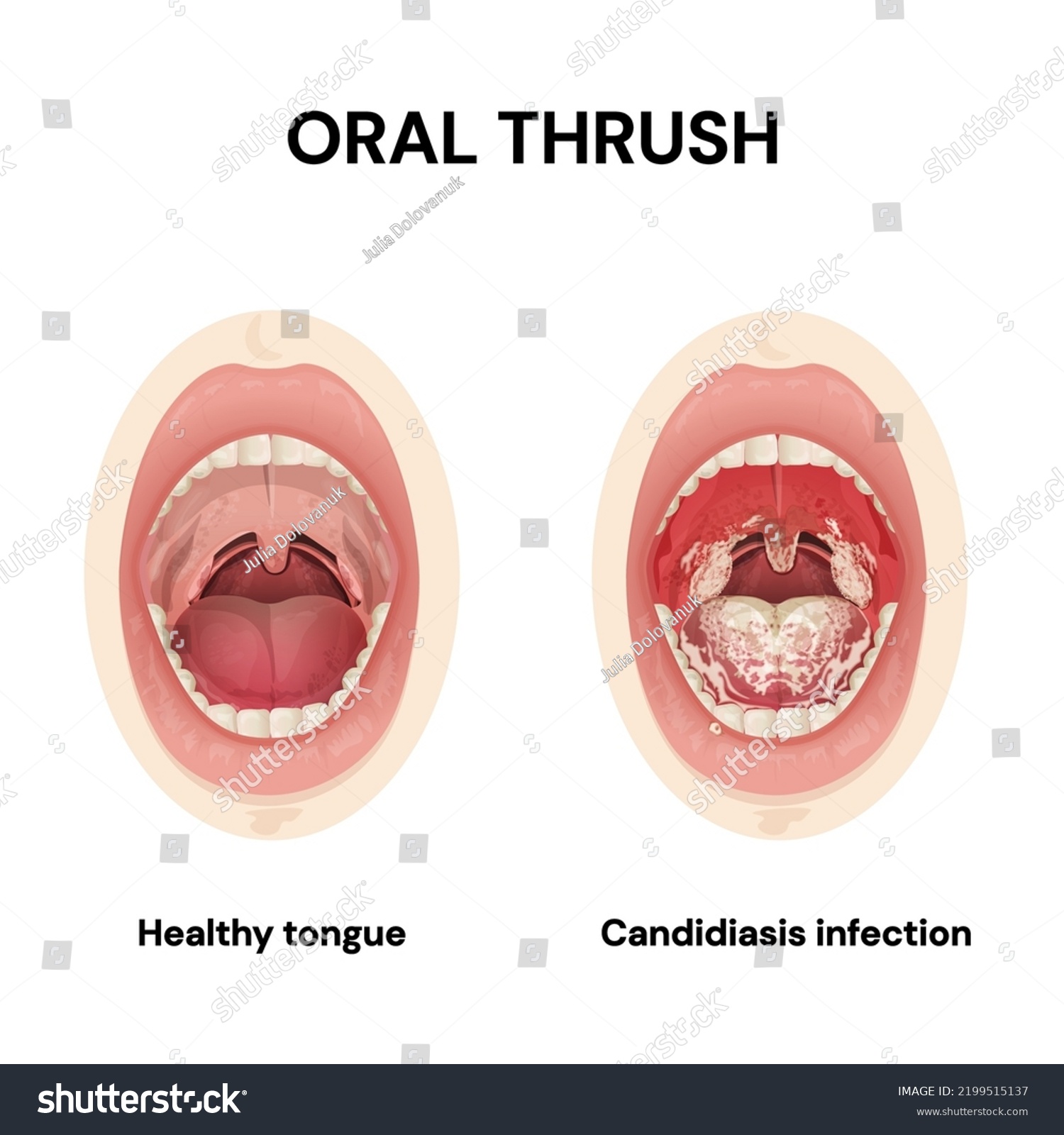 Oral Thrush Candidiasis Symptomscandida Infections Mouth Stock Vector 