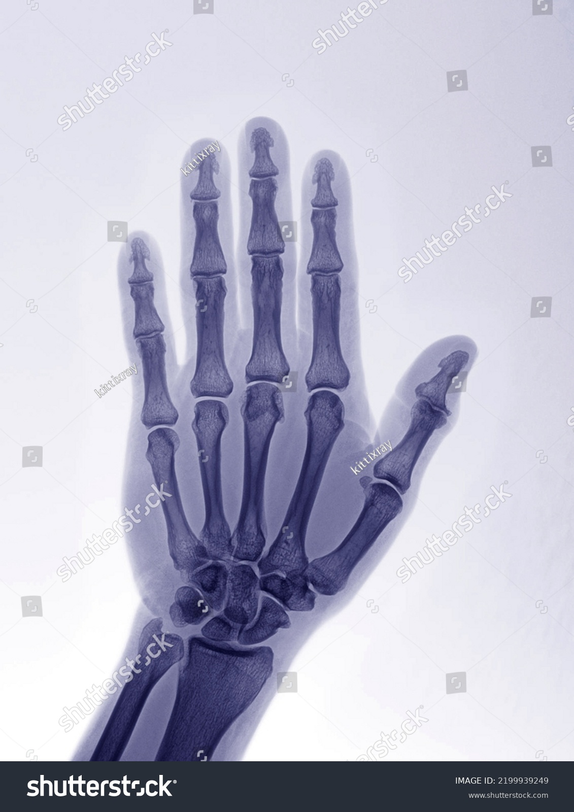 Translucent Xray Images Fingers Normal Symptoms Stock Photo 2199939249 ...