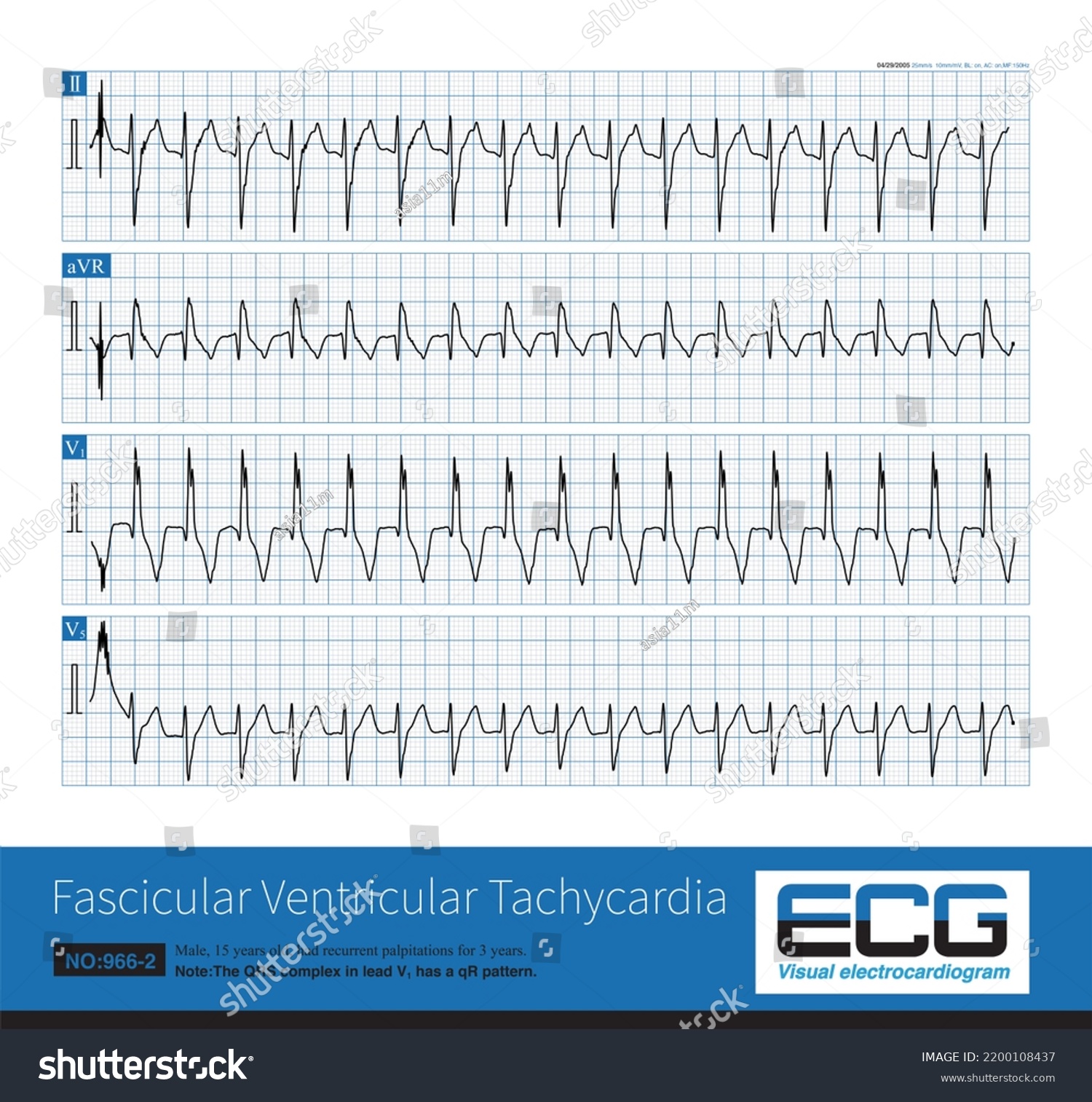 Fascicular Ventricular Tachycardia Idiopathic Ventricular Tachycardia ...