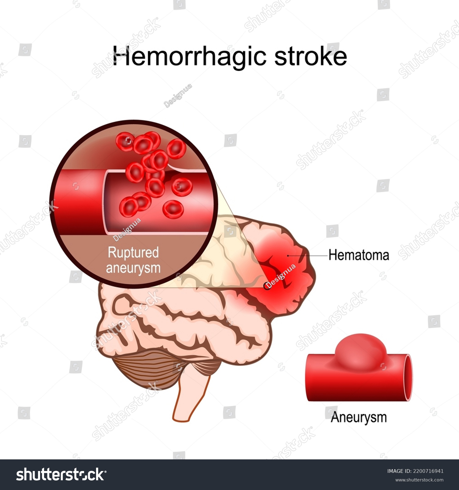 Hemorrhagic Stroke Human Brain Hematoma Closeup Stock Vector (Royalty ...