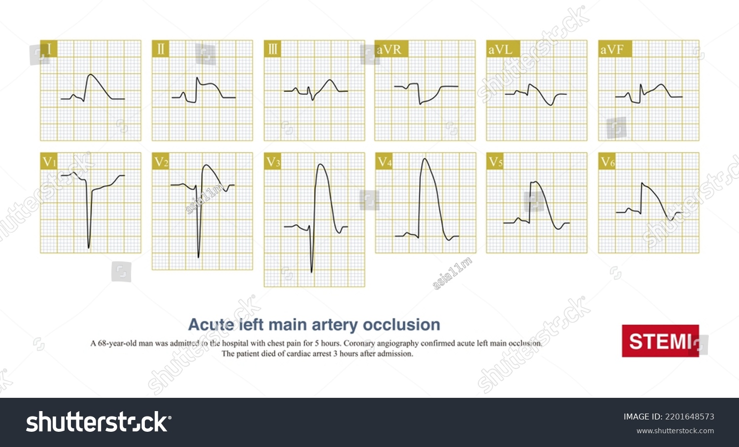 Acute Left Main Artery Occlusion Can Stock Illustration 2201648573 ...