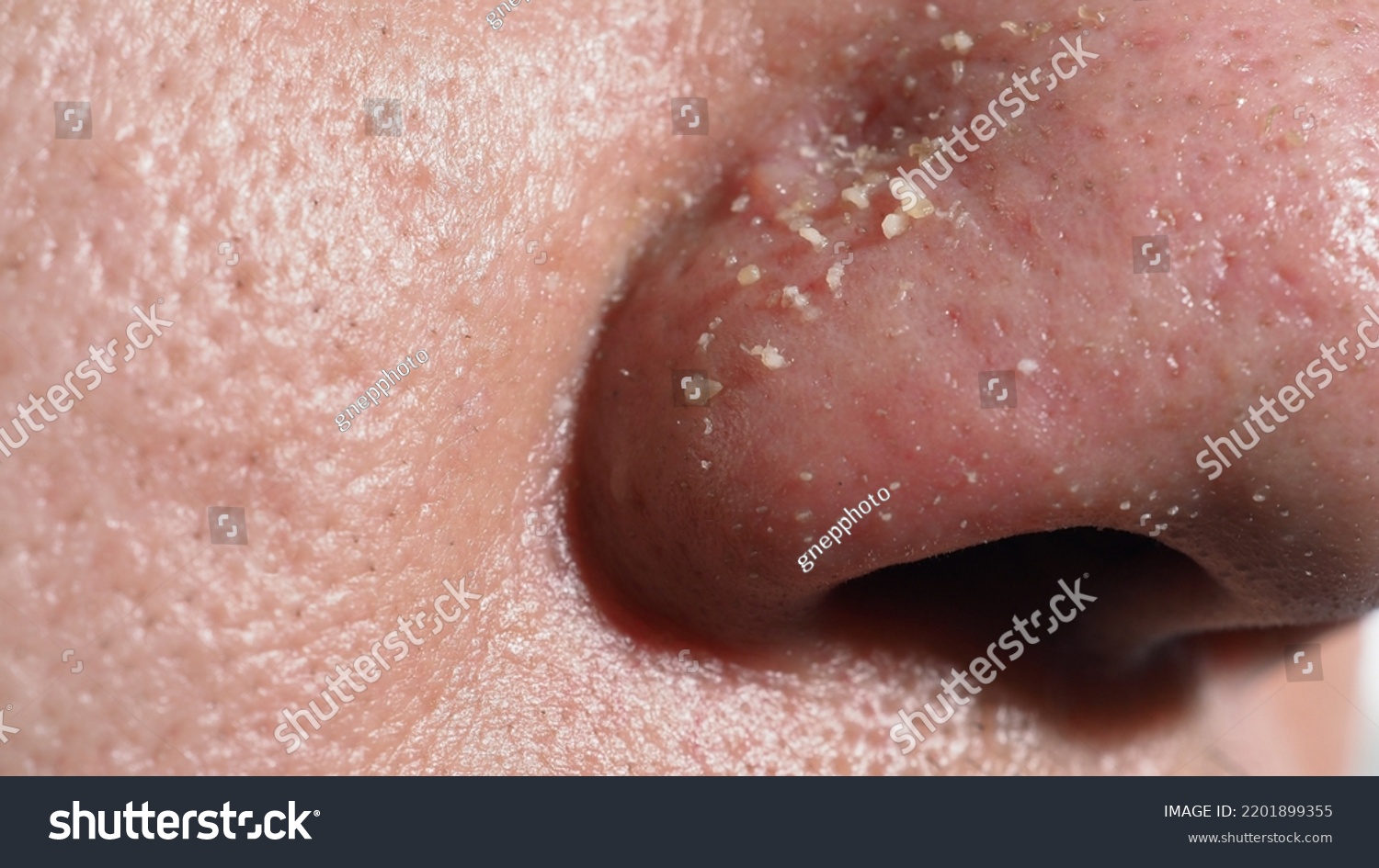 Acne Problem Pores Squeezing Blackhead Pimple Stock Photo 2201899355 ...