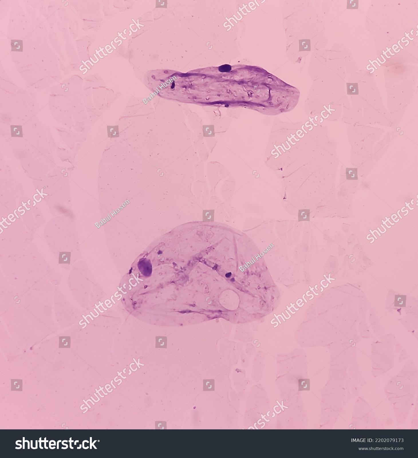 Lower Flank Cytology Lipoma Benign Growth Stock Photo 2202079173 ...