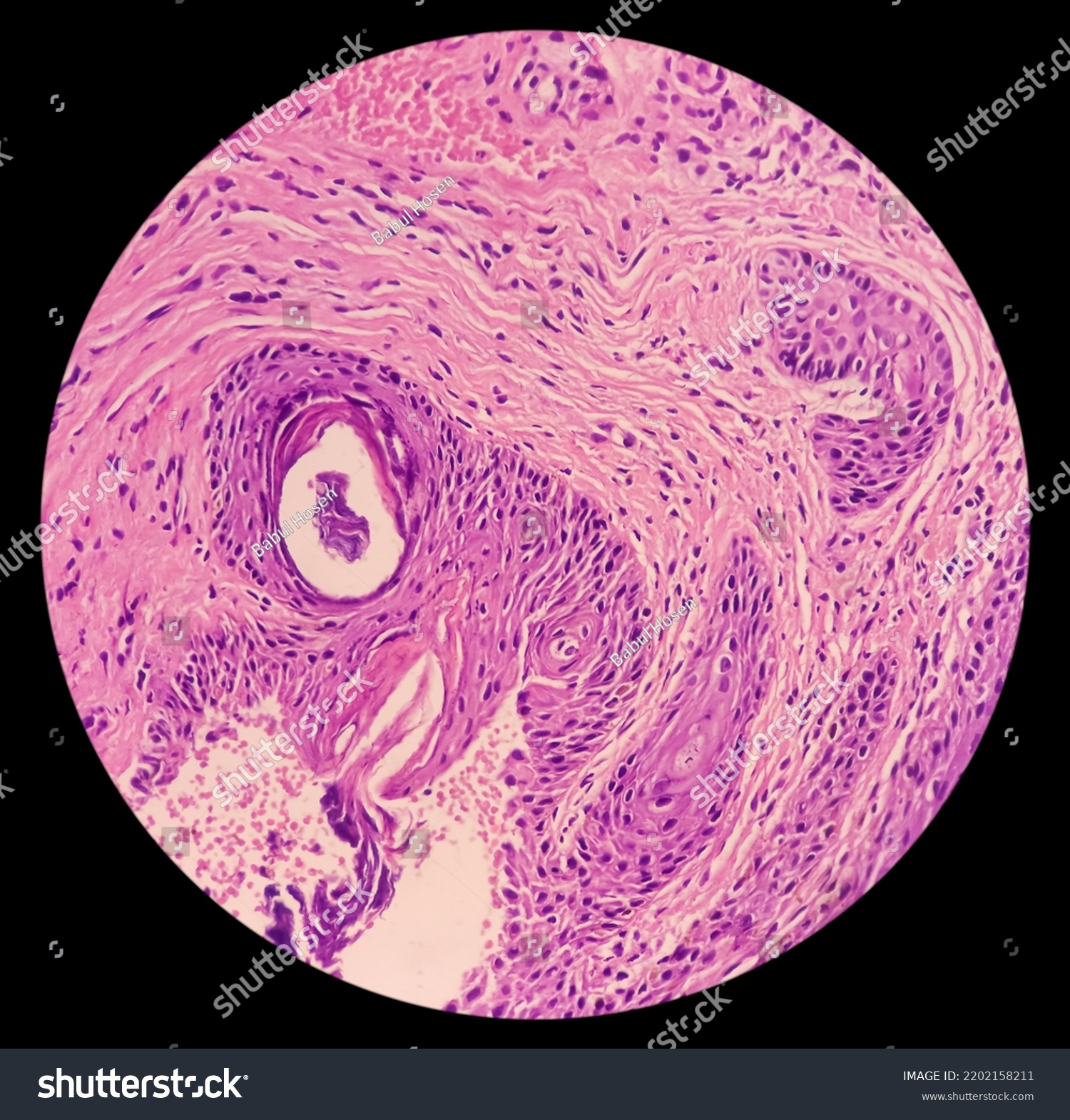 Punch Biopsy Face Skin Face Skin Stock Photo 2202158211 Shutterstock