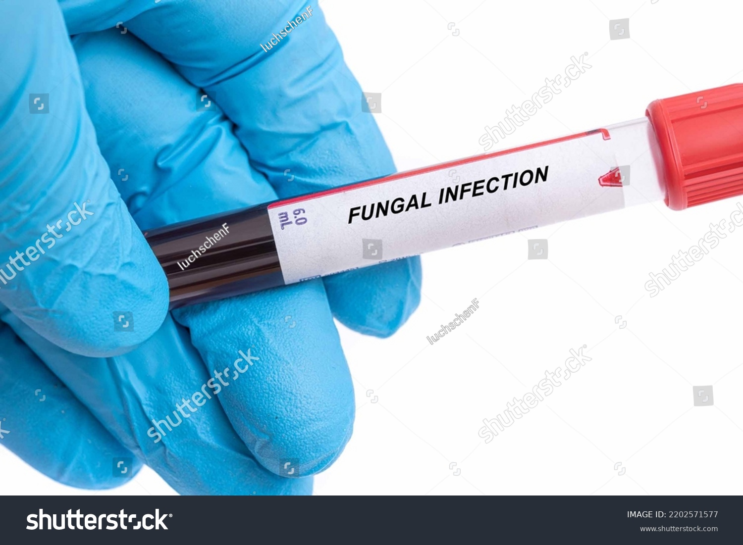 Fungal Infection Fungal Infection Disease Blood Stock Photo 2202571577