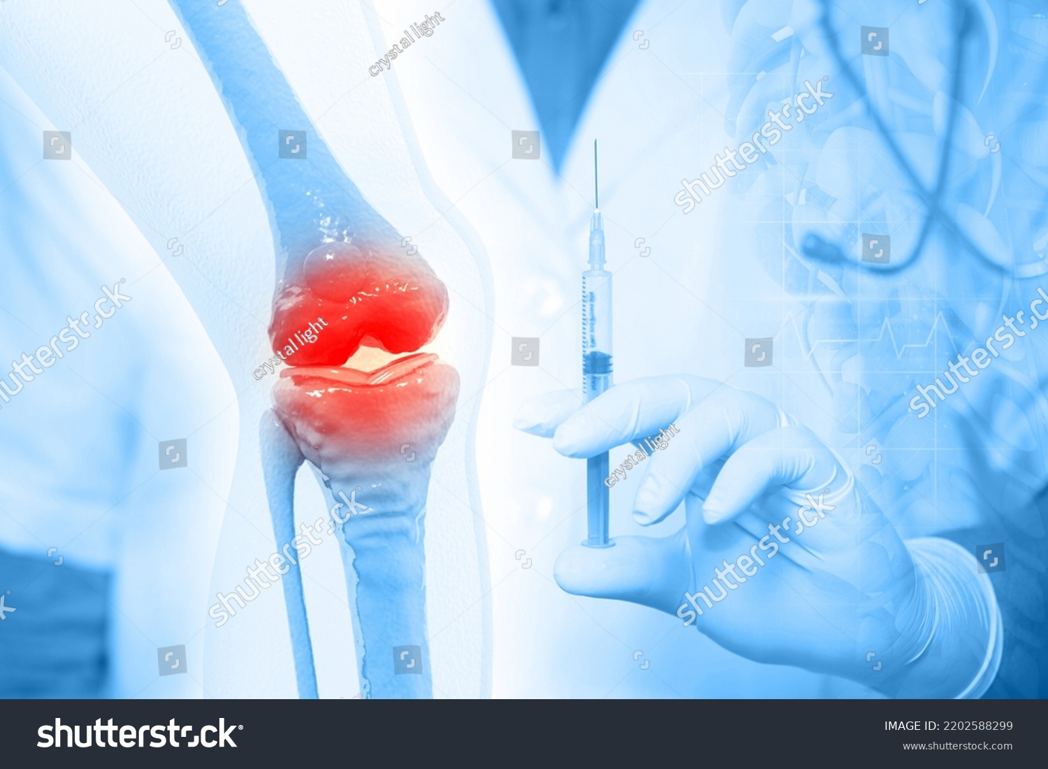 Anatomy Human Knee Joint Treatment Osteoarthritis Stock Illustration ...