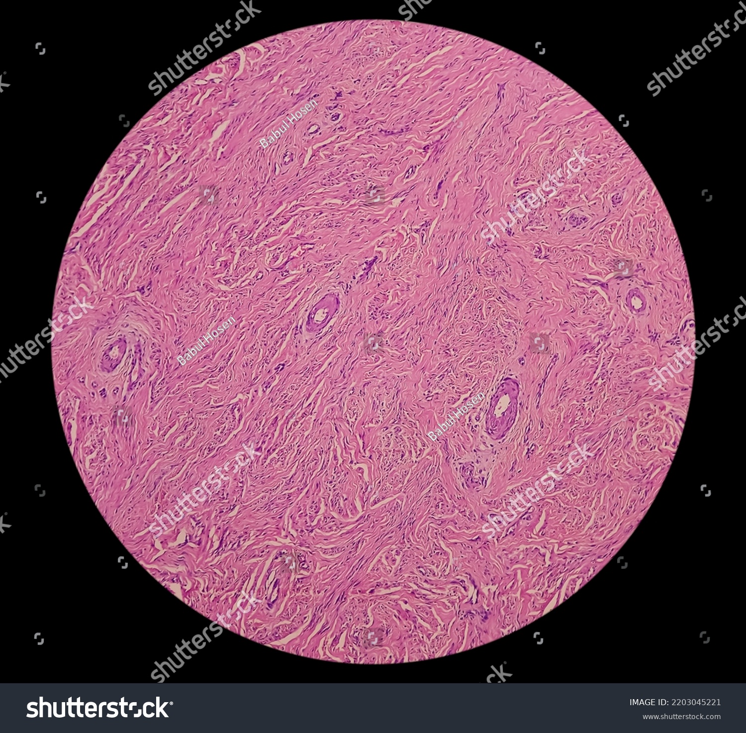 Uterus Biopsy Chronic Cervicitis Squamous Metaplasia Stock Photo ...