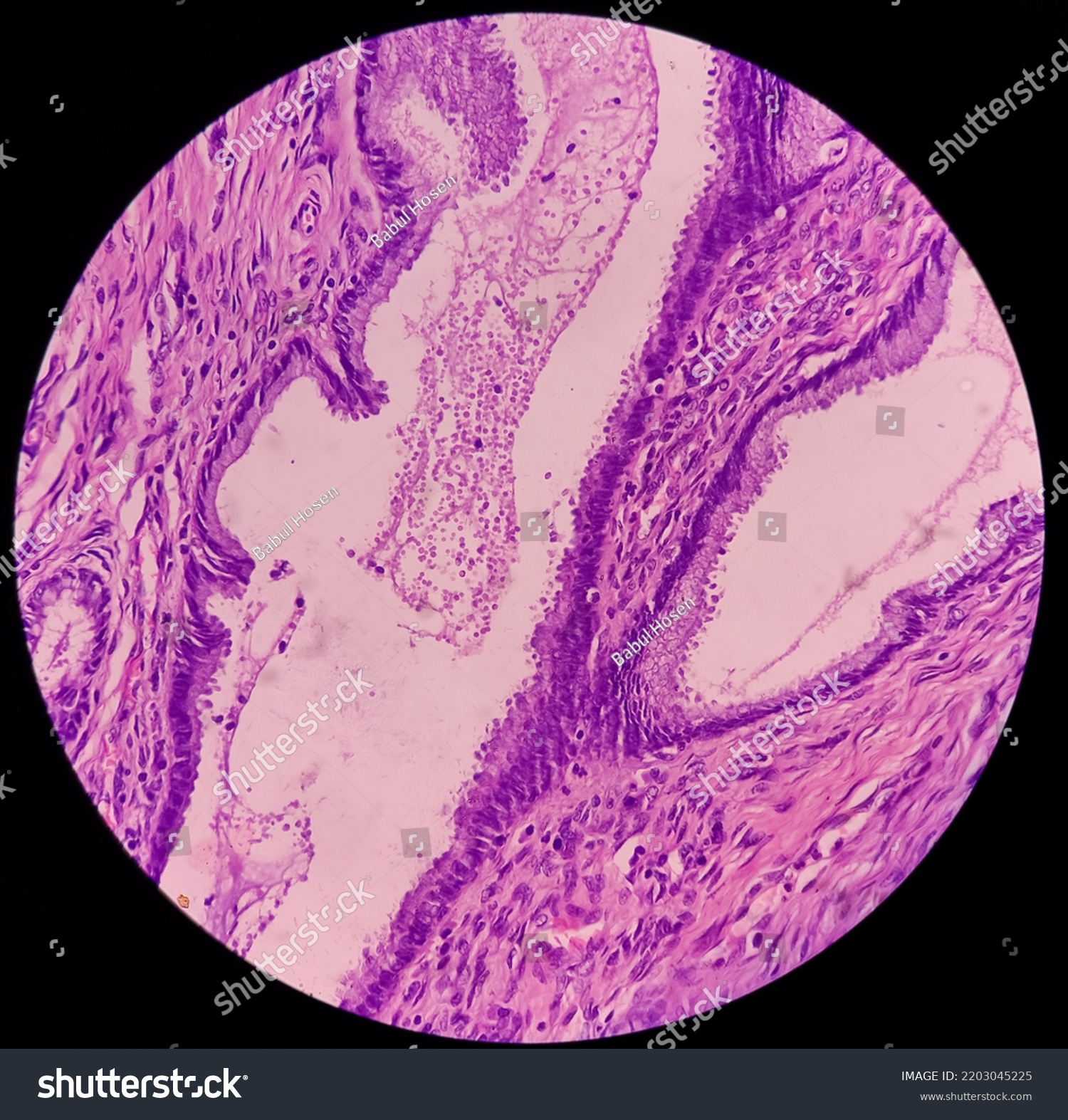 Uterus Biopsy Chronic Cervicitis Squamous Metaplasia Stock Photo ...