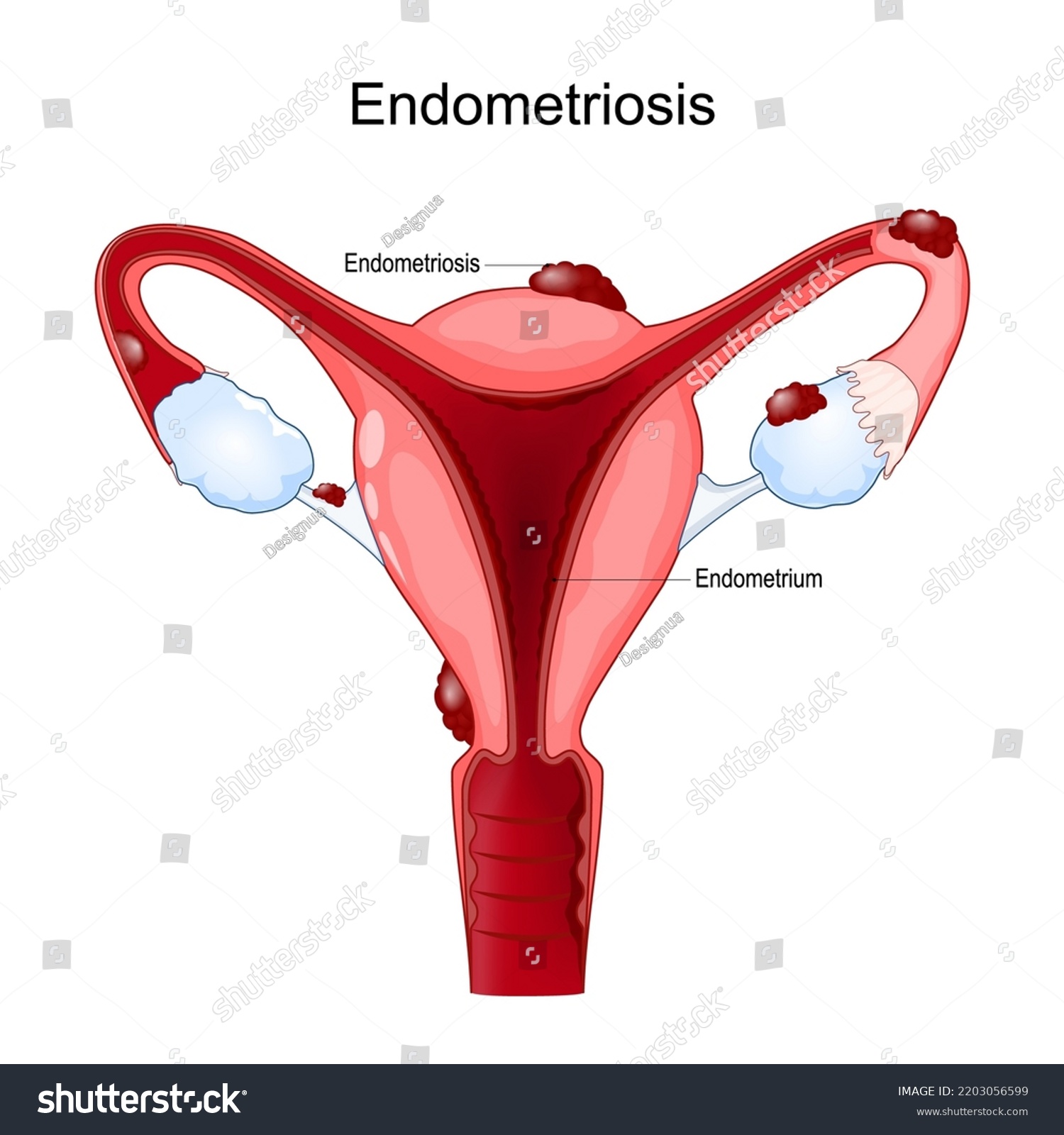 Endometriosis Female Reproductive System Human Uterus Stock Vector Royalty Free 2203056599 9434