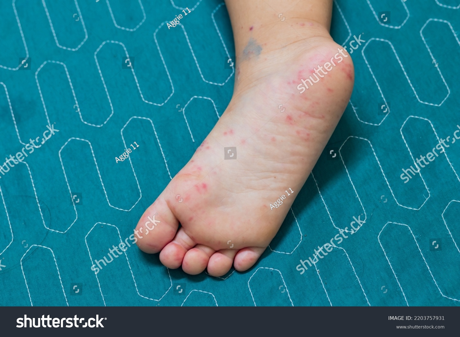 Enterovirus Leg Arm Mouth Rash On Stock Photo 2203757931 | Shutterstock