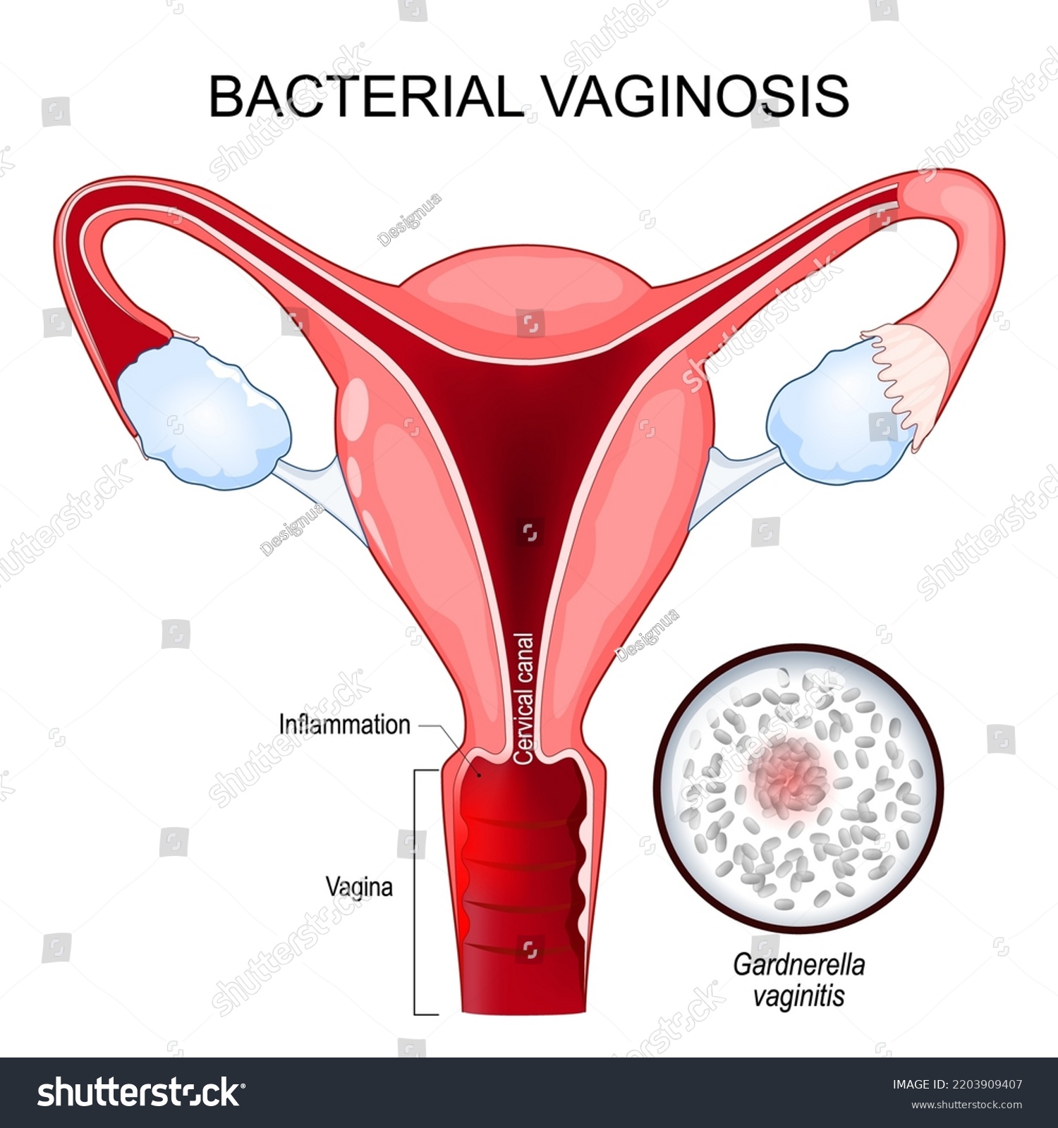 Bacterial Vaginosis Disease Vagina Caused By Stock Vector Royalty Free 2203909407 Shutterstock 8509