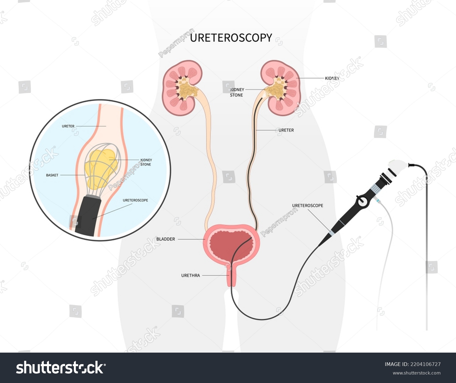 178-ureteral-stone-shutterstock