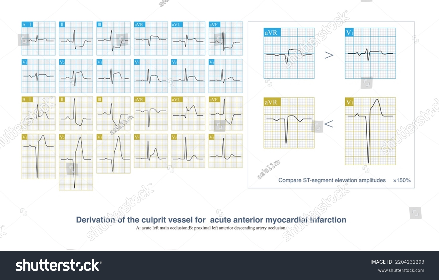 Acute Extensive Anterior Myocardial Infarction Culprit Stock ...