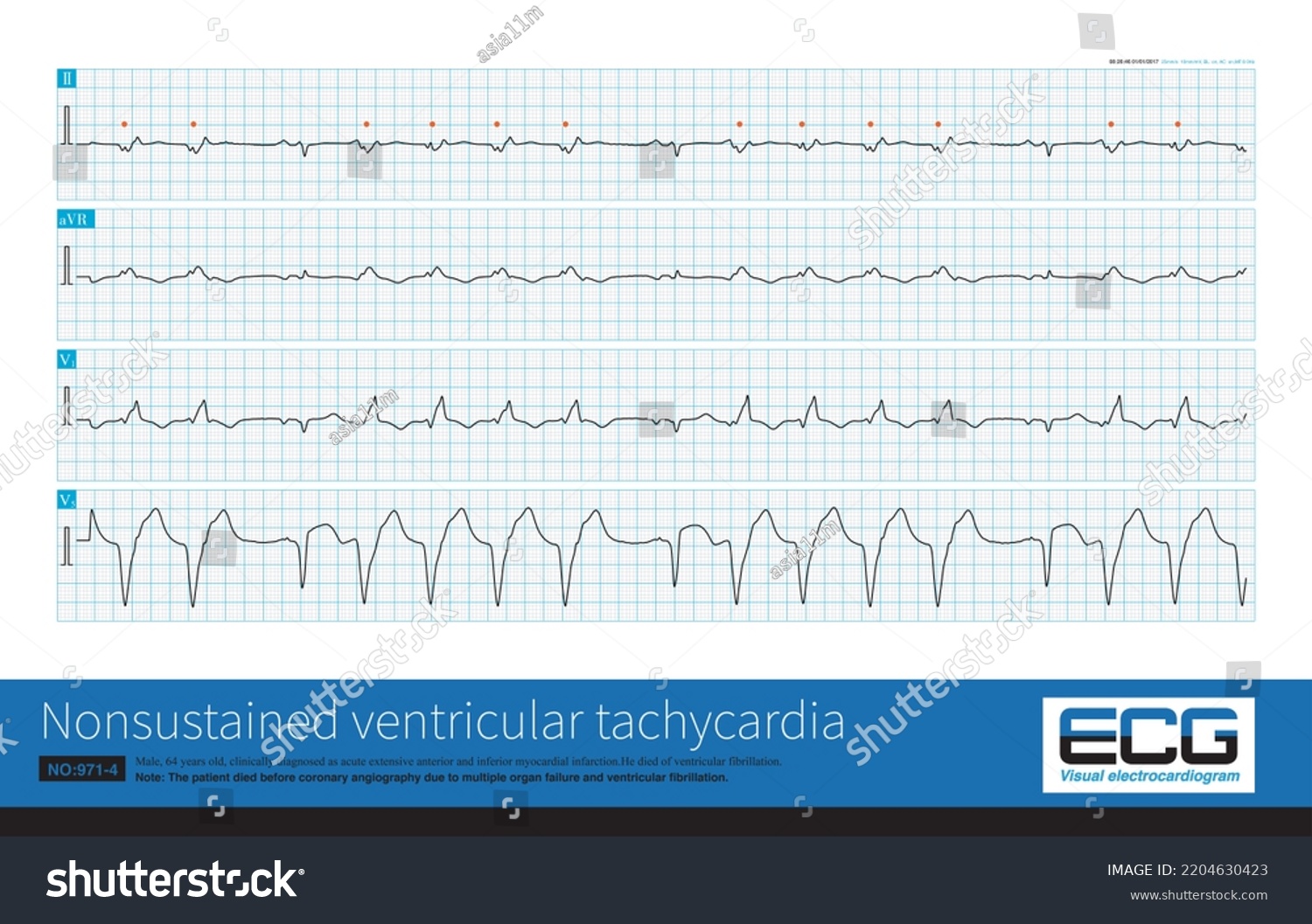 This Case Patient Acute Extensive Anterior Stock Illustration ...