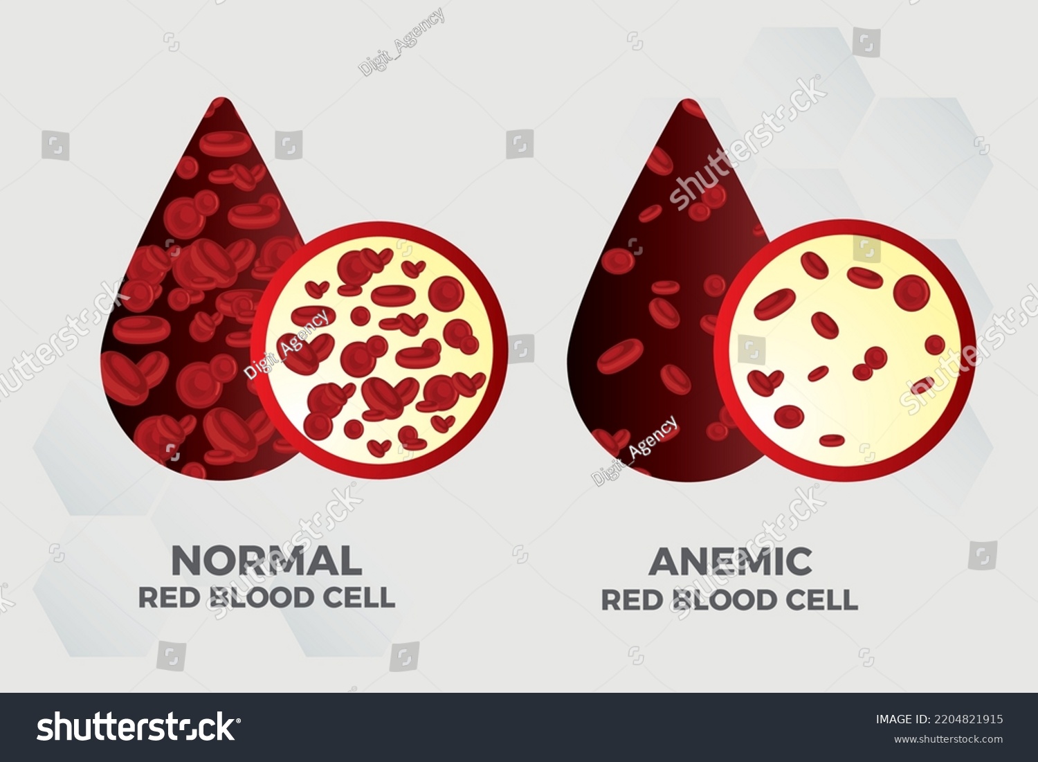 Anemia Iron Red Blood Cell Medical Stock Vector (Royalty Free ...