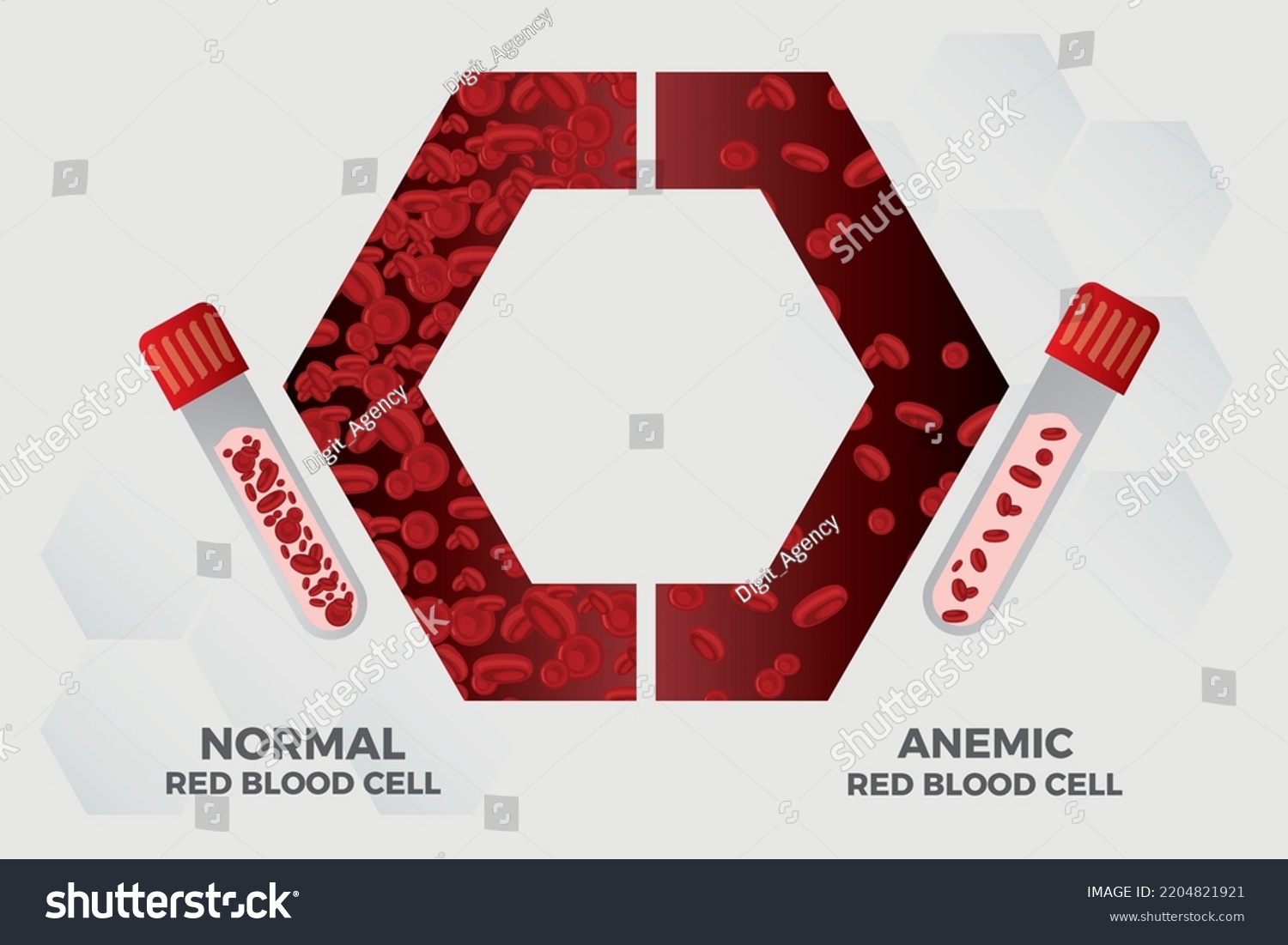 Anemia Iron Red Blood Cell Medical Stock Vector (Royalty Free ...