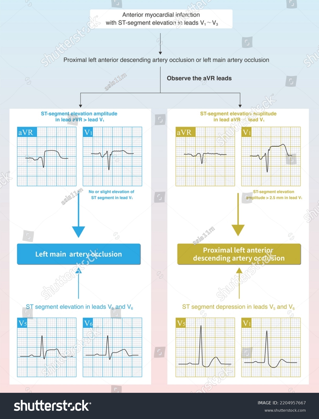 Case Acute Anterior Myocardial Infarction Characteristics Stock ...